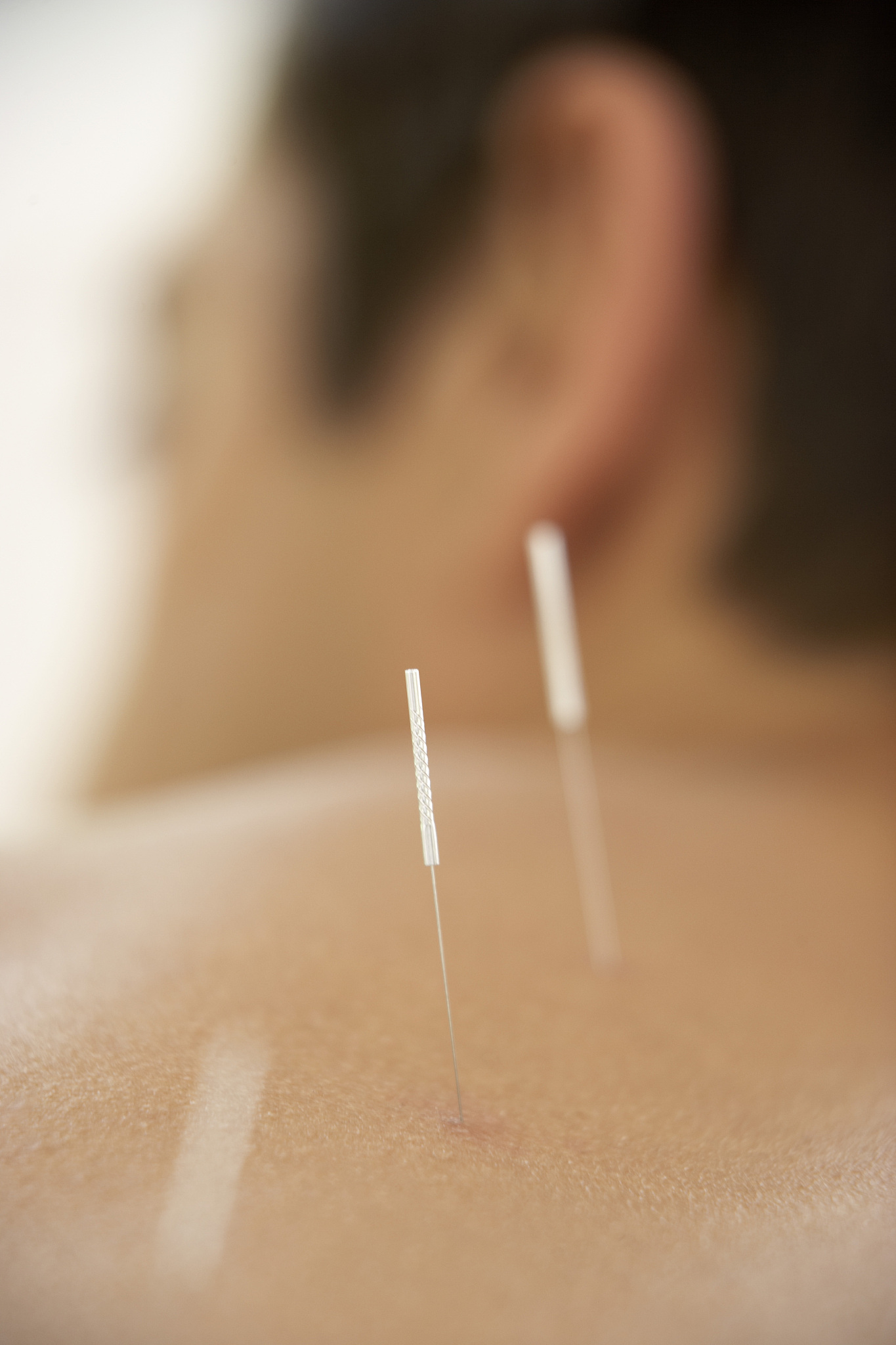 acupuncture needles on man's back