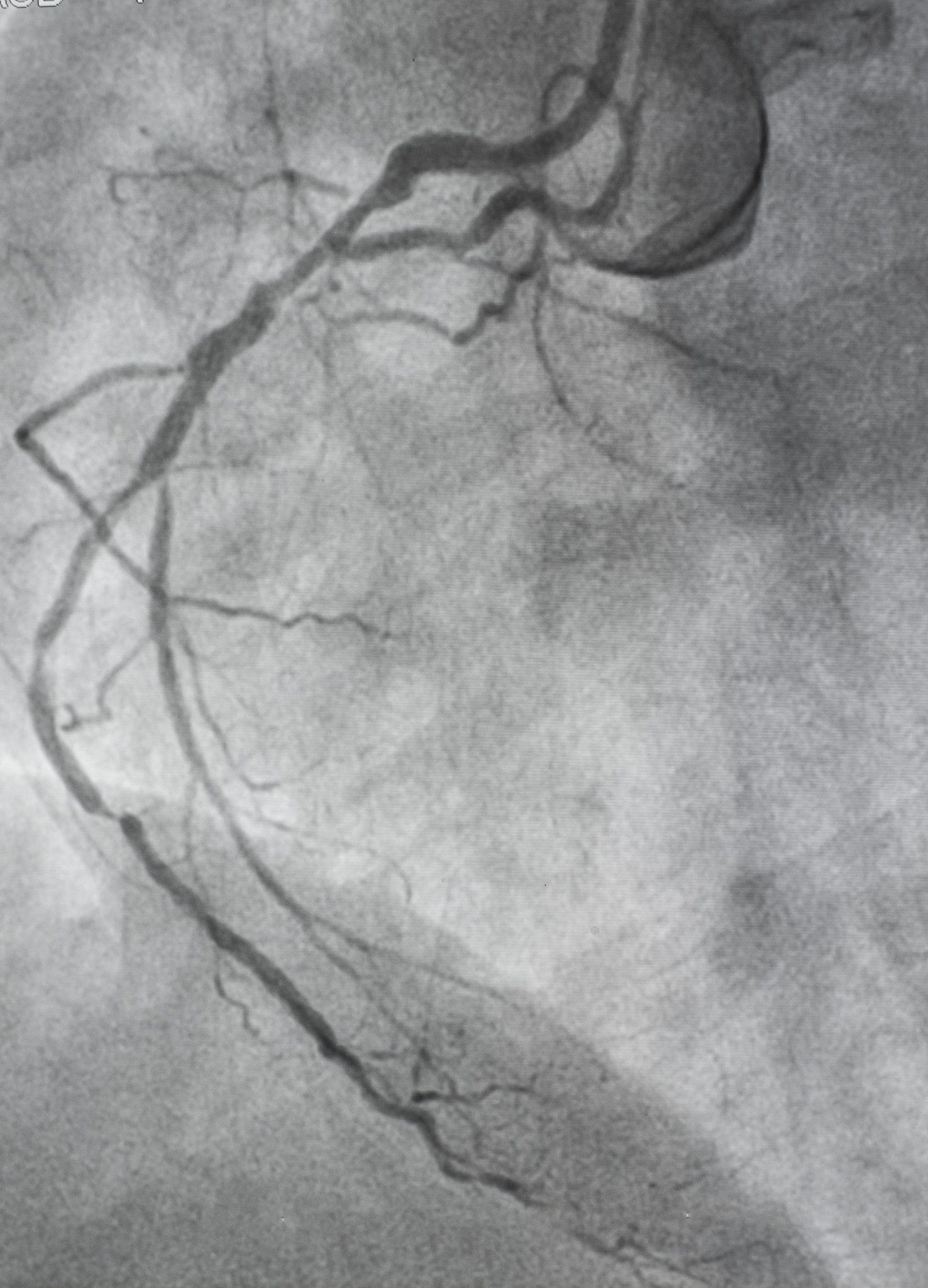 冠脉介入术在导管室实施现状