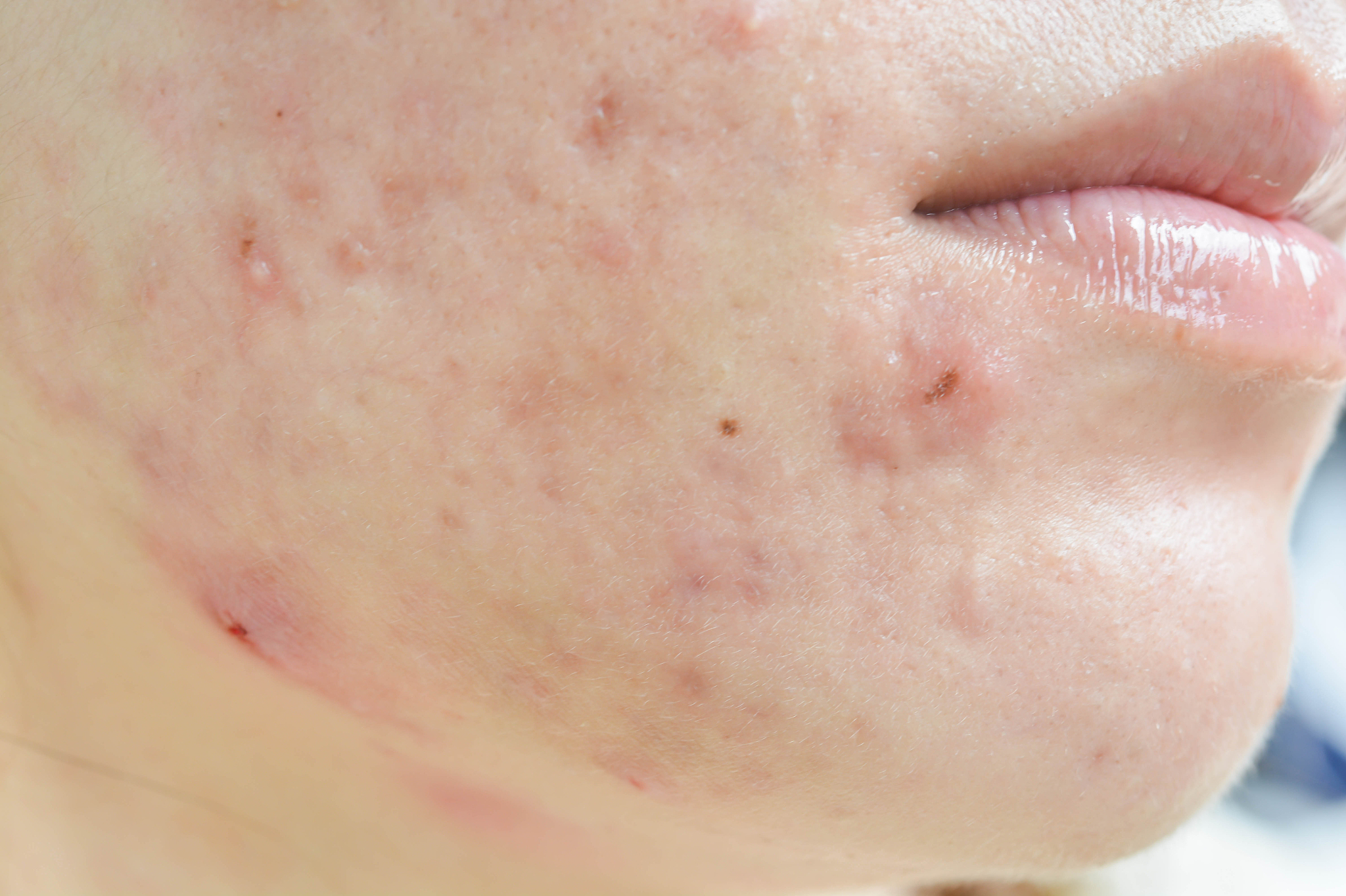 有效祛痘方法：从饮食到护肤，全面改善痘痘问题