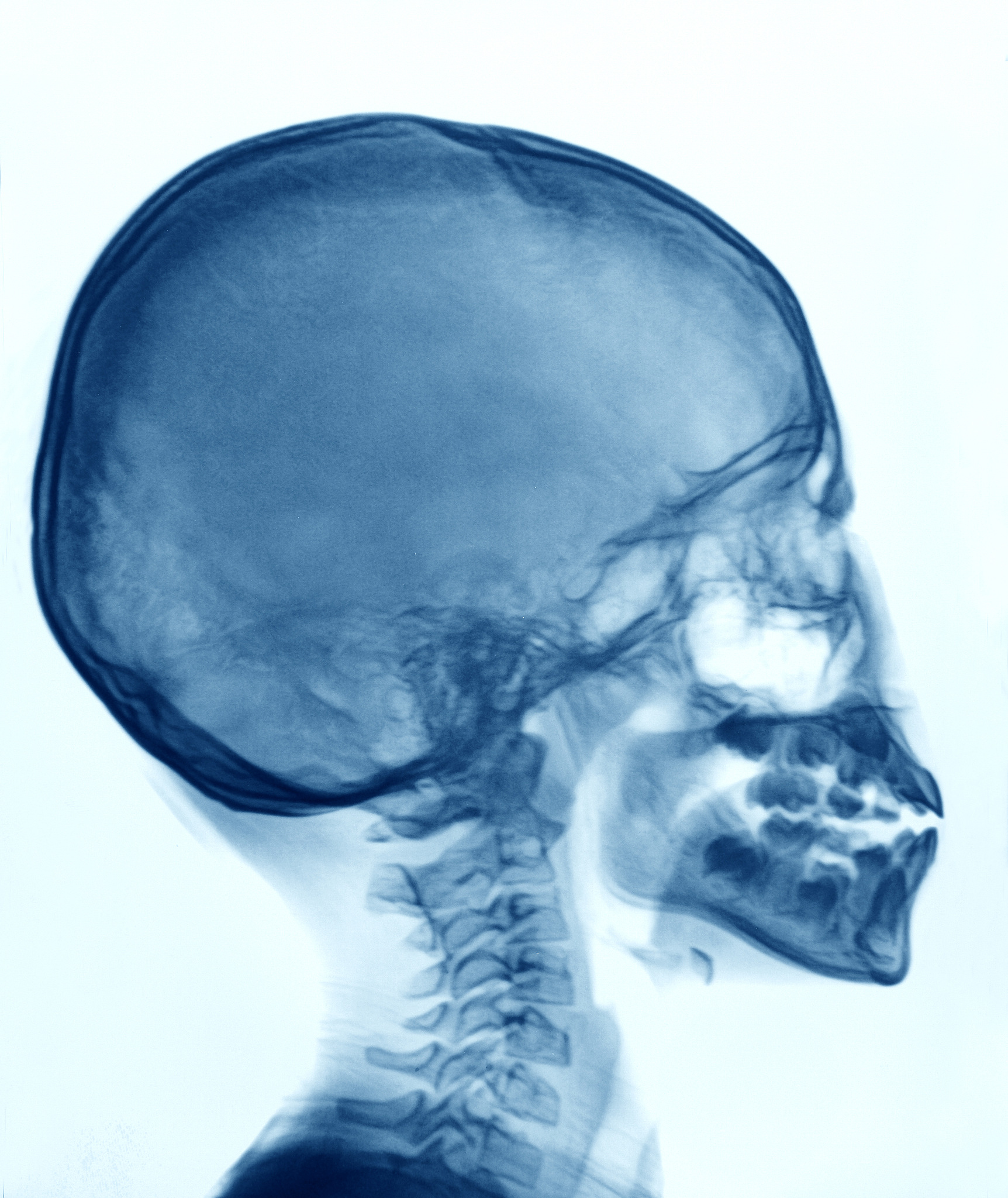硬脊膜意外穿破后头痛