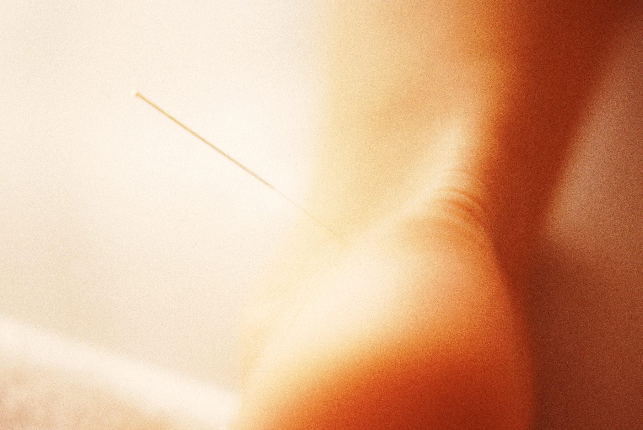 acupuncture needle in an ankle