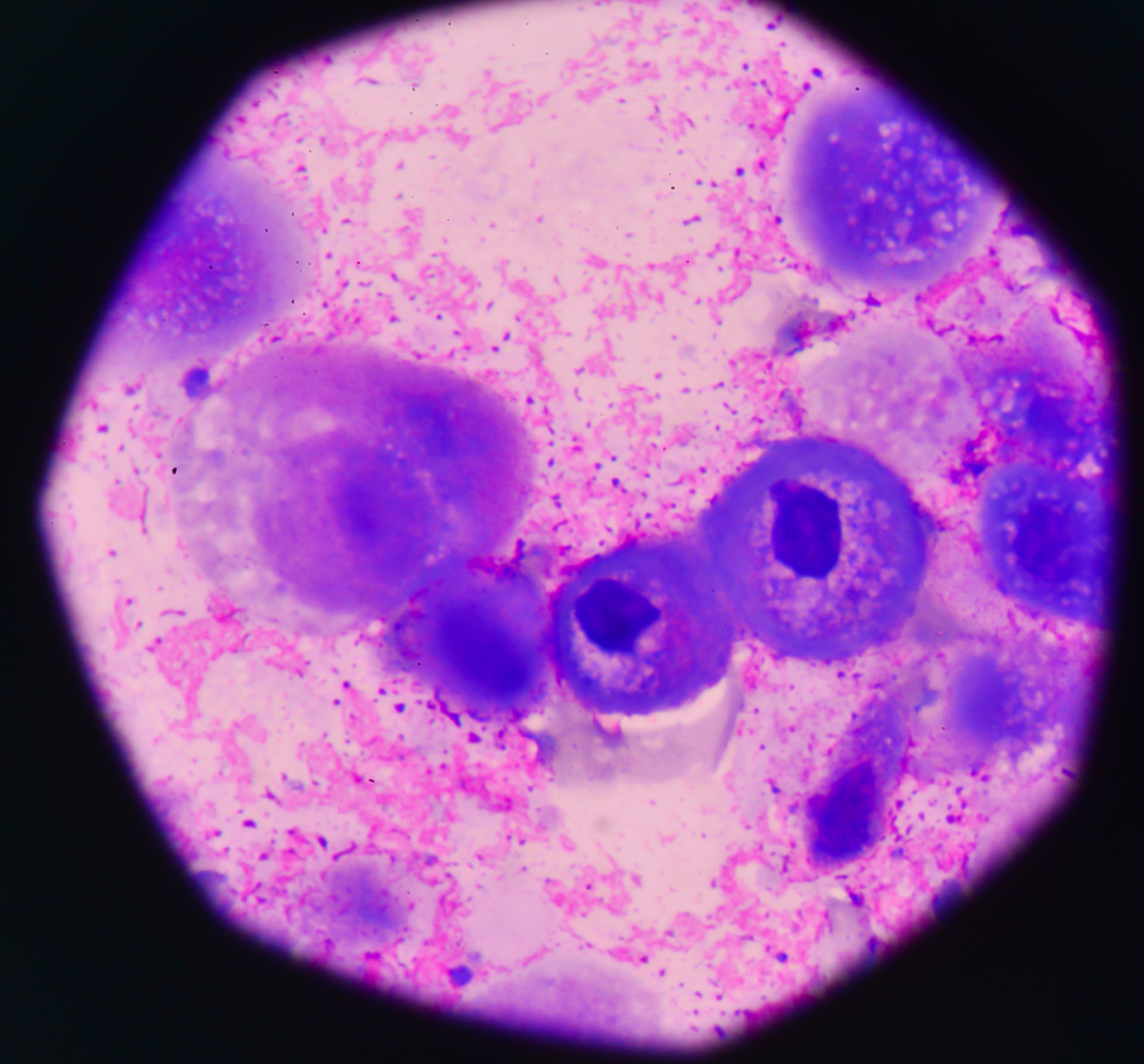EGFR免疫组化结果解读：阳性、阴性及弱阳性结果分析