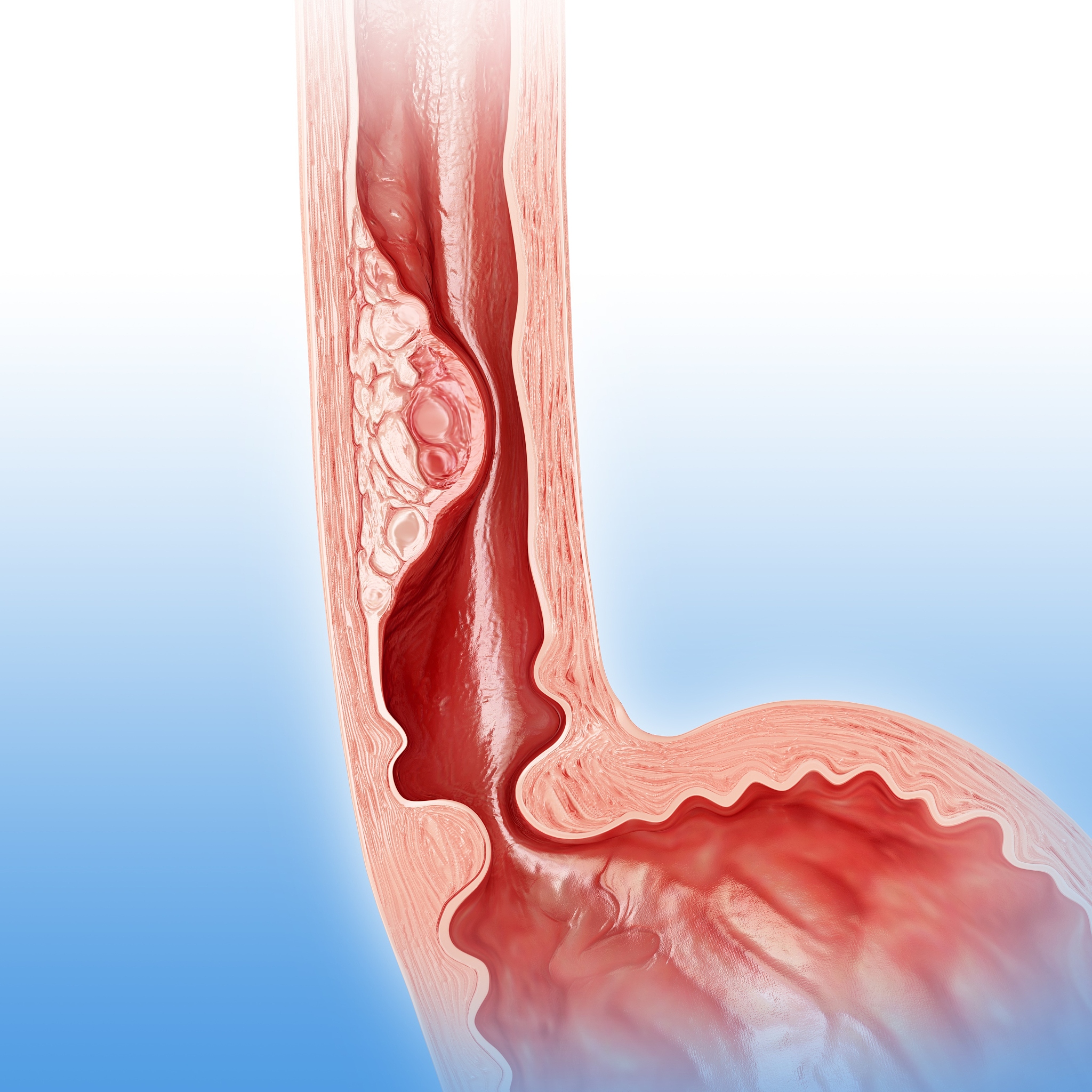 克罗恩病的常见并发症