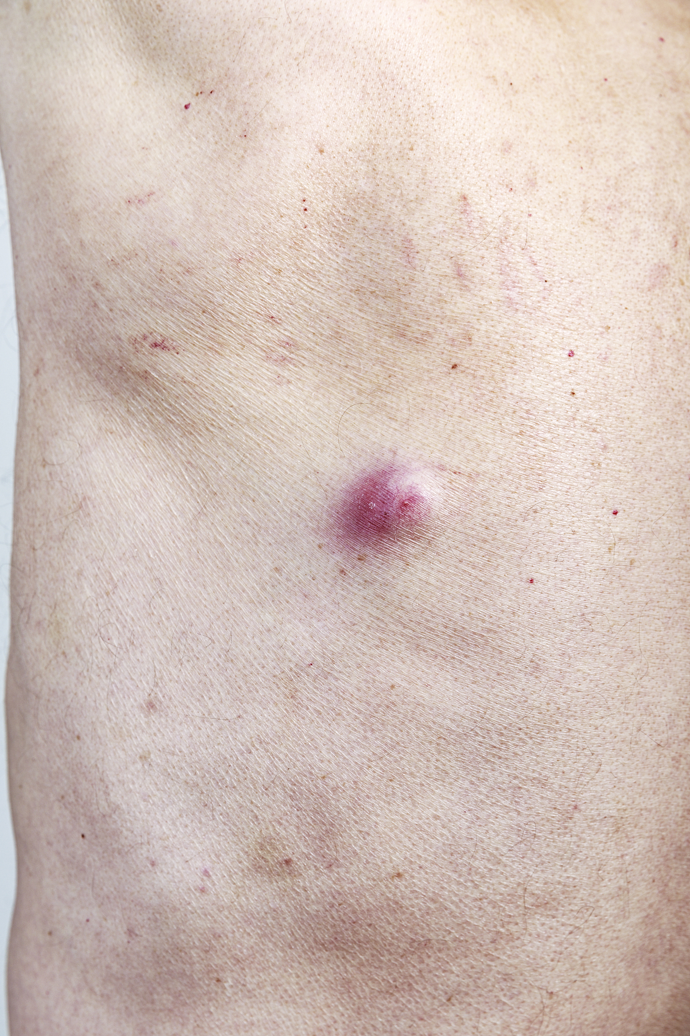 sebaceous cyst on man's back showing red inflammation
