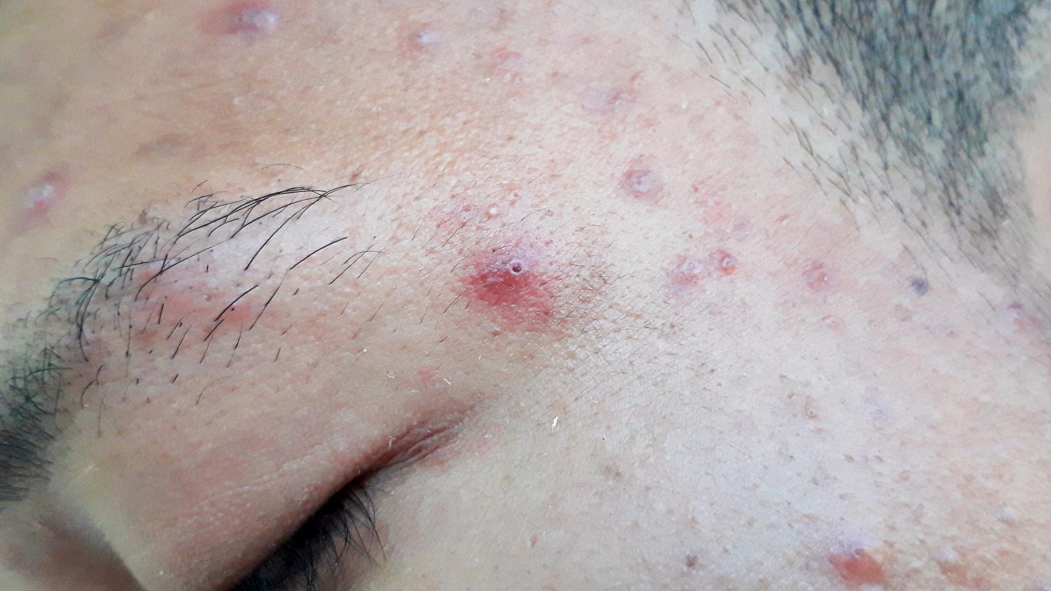 acne blotch