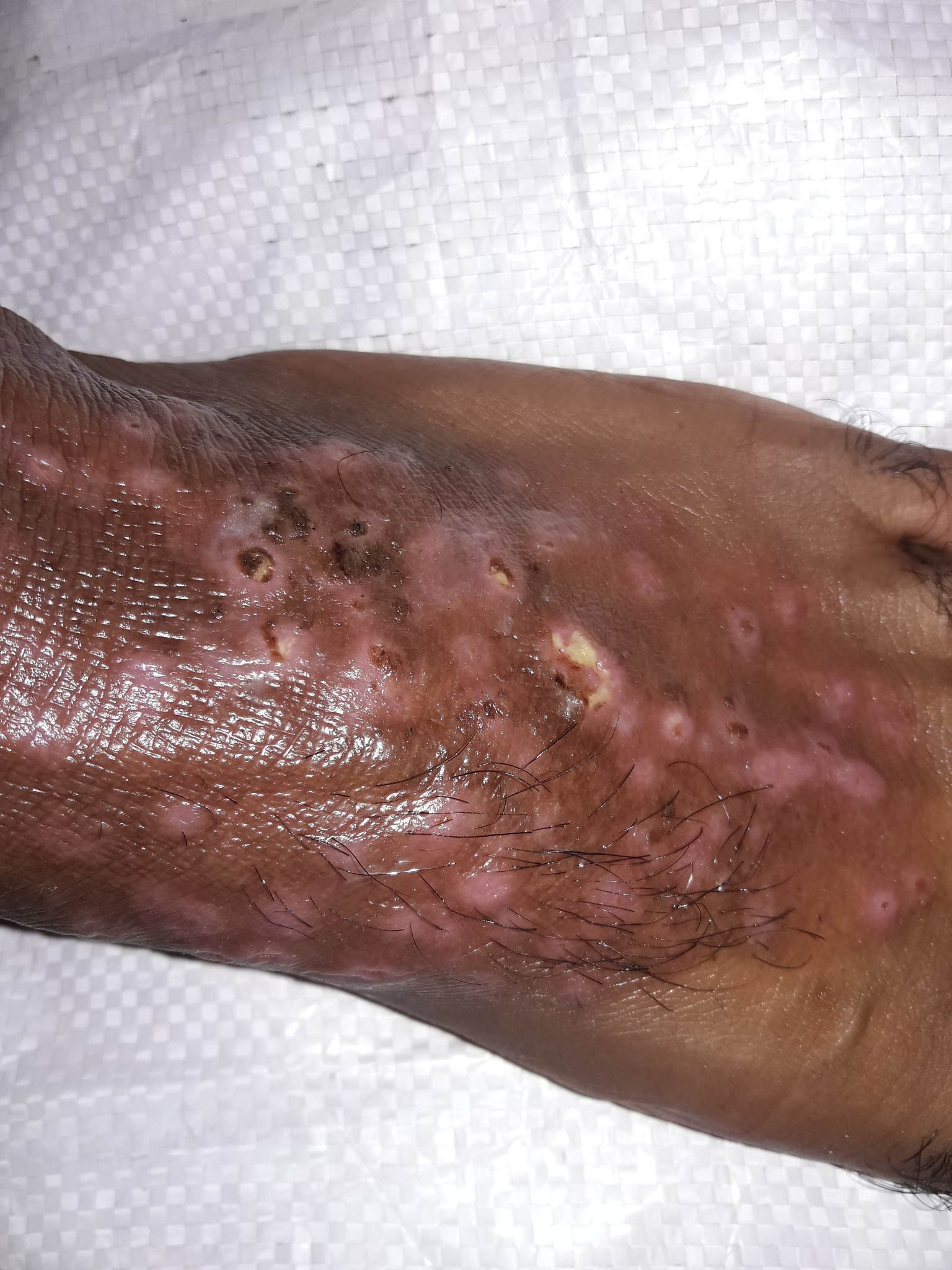 溃疡和糜烂的区别：症状、病理和病因解析