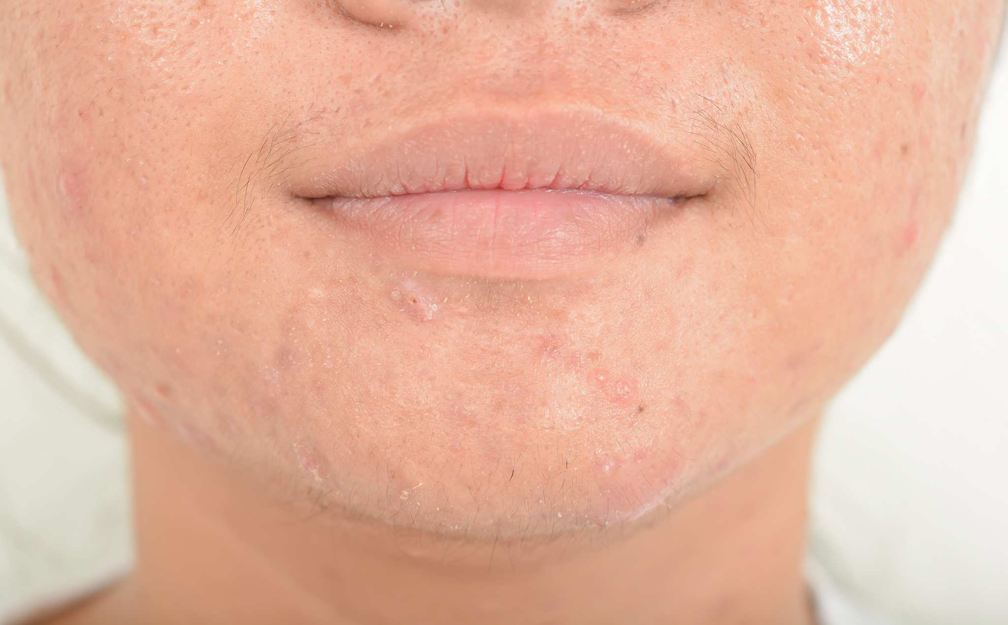 青春痘：原因、预防和治疗方法 - 全面解析