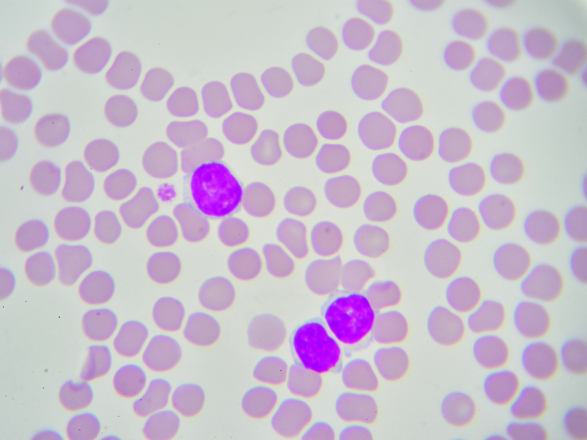 急性红细胞白血病诊断标准 - 罕见白血病亚型