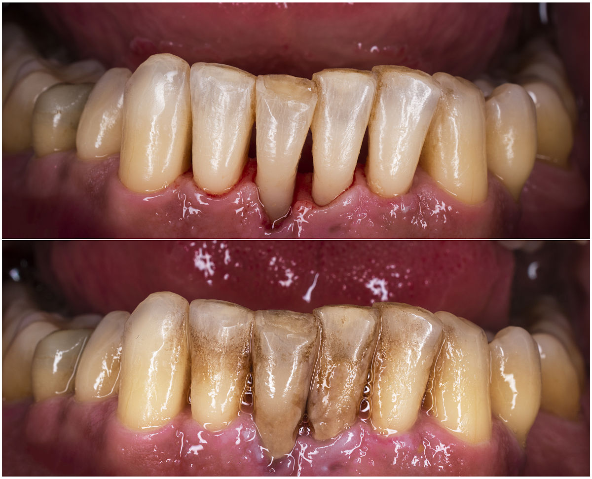 西安护理学校：美白牙齿的有效方法和实用医疗知识
