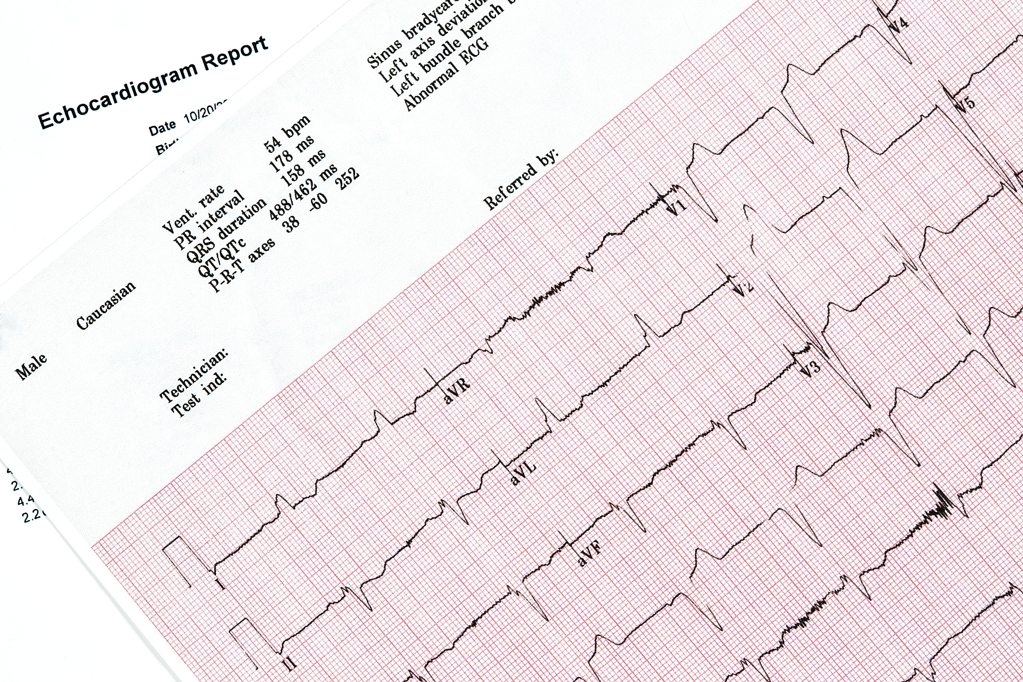 TMHMM预测结果是outside，这个outside指的是外膜还是内膜的ES面