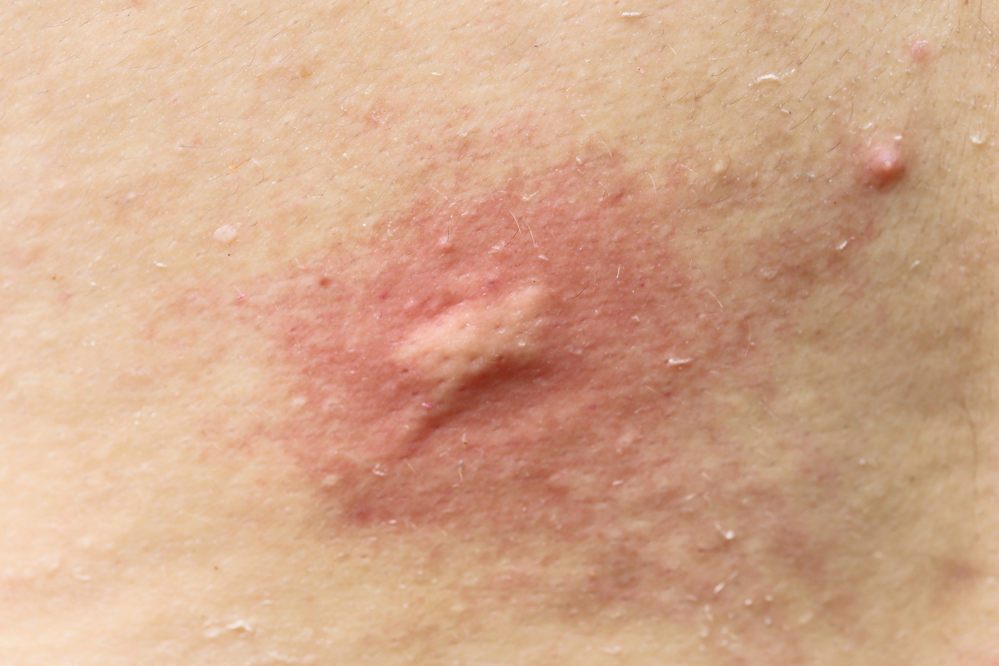 mosquito bites on body