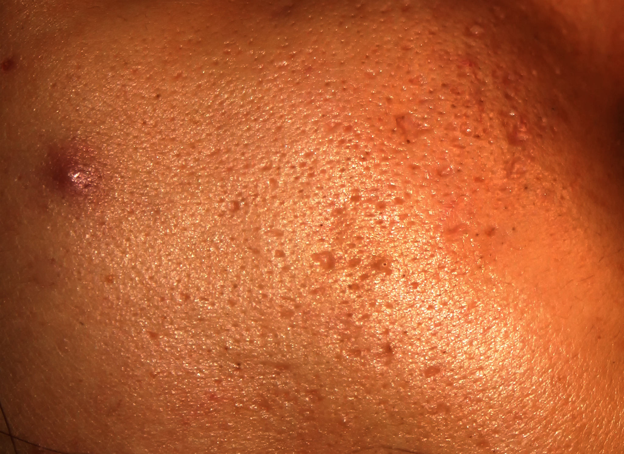 inflamed skin of the face in pimples and acne. keloid scars from