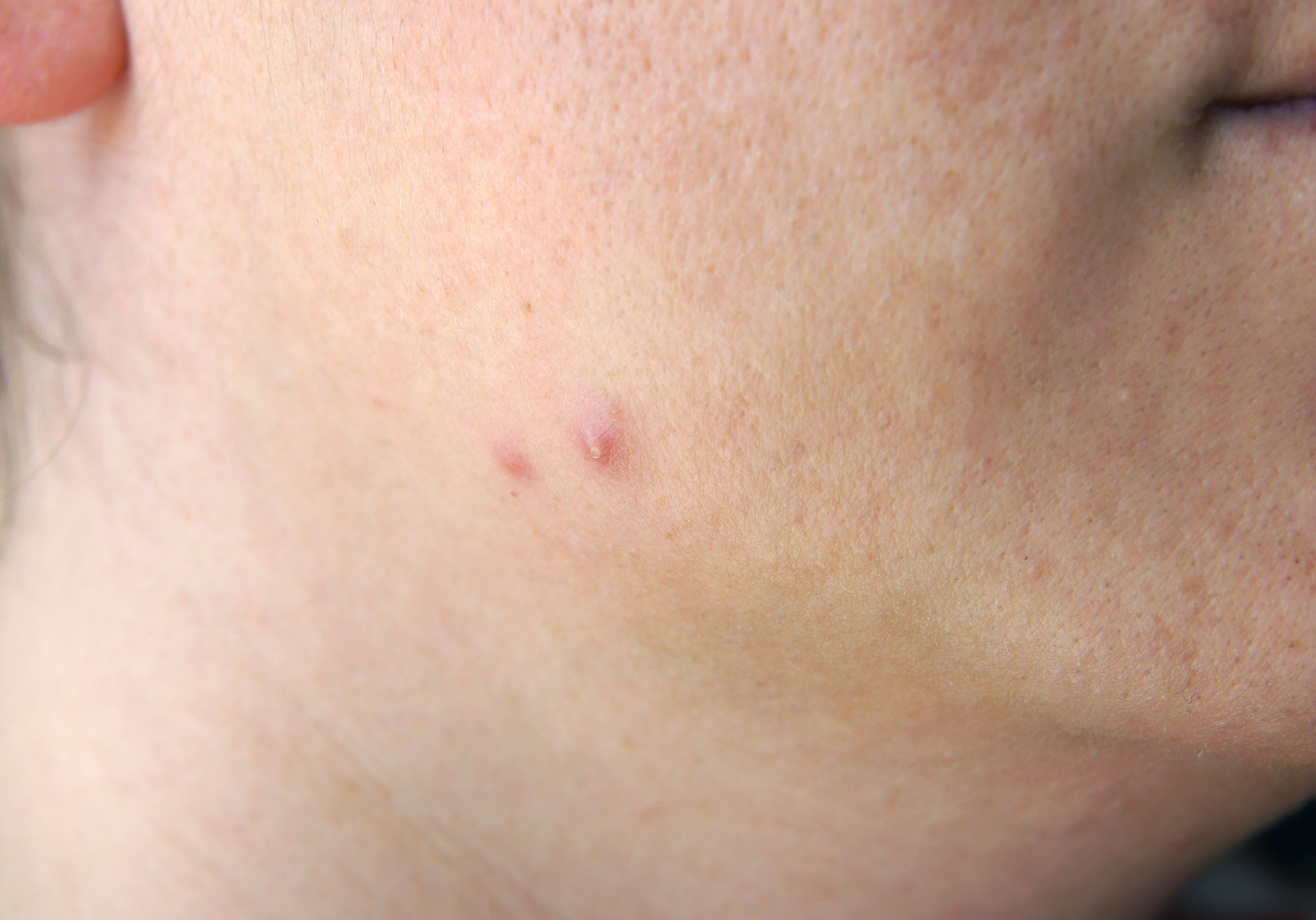 pimple on face