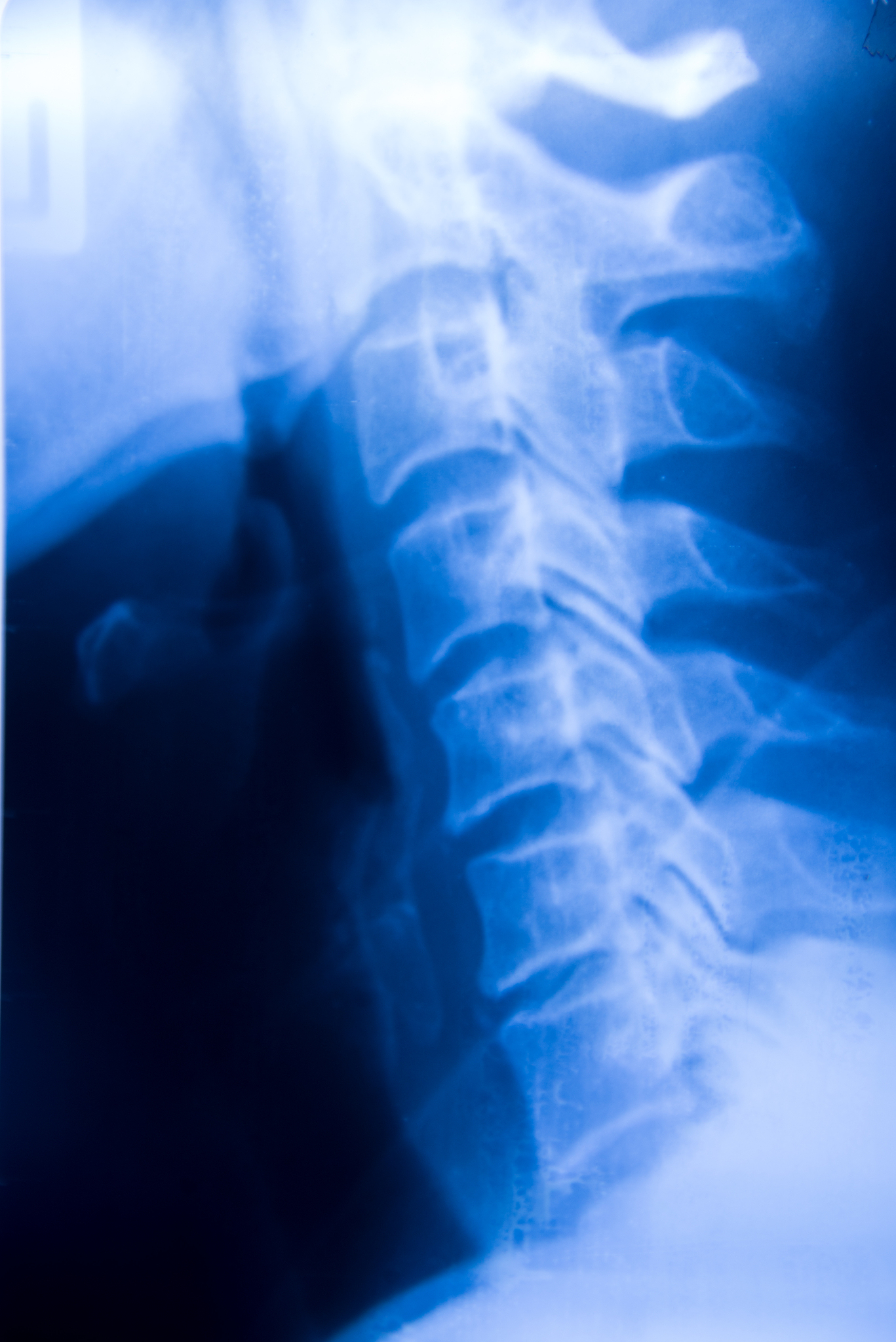 请骨科的文章关于椎体成形术治疗胸腰椎压缩骨折的文章要有摘要和内容