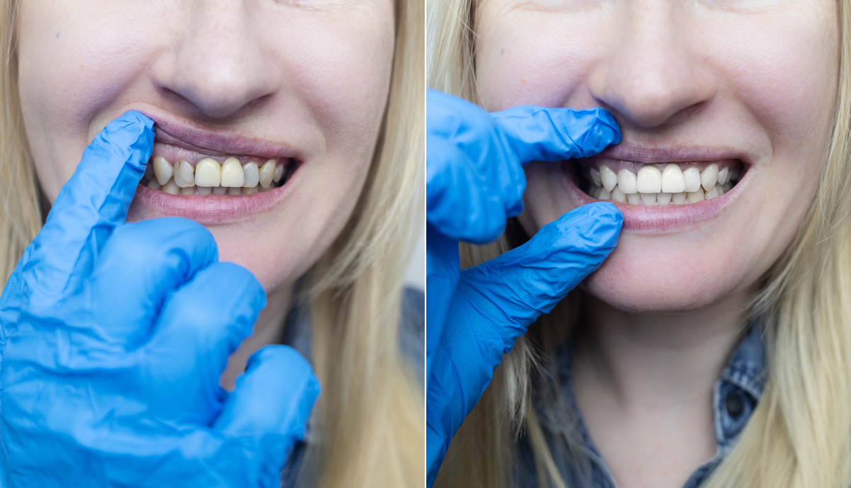 牙齿缺损怎么办？自己也能修补吗？