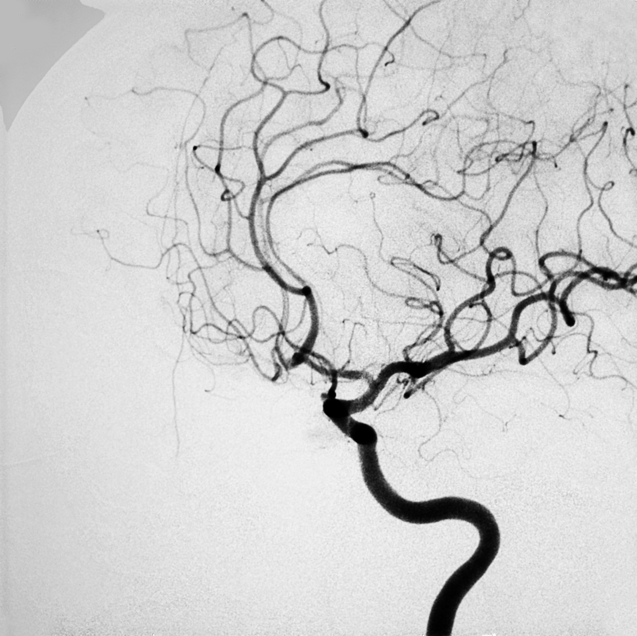 Ultrasound Imaging Prevents Stroke Risk from Carotid Artery Thrombus