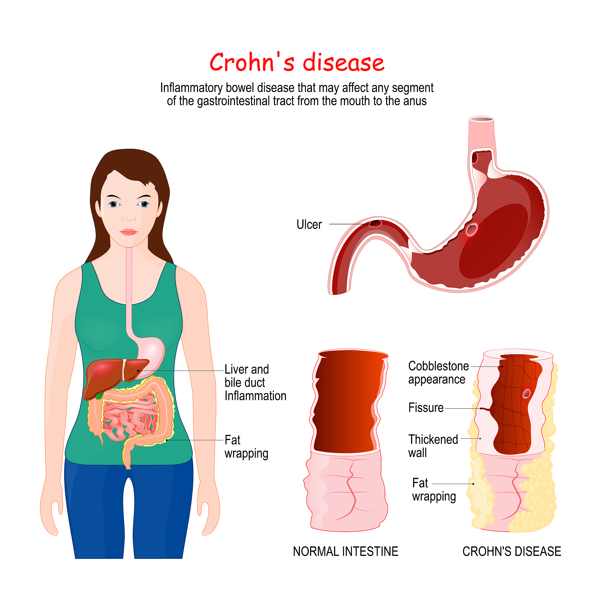 胃肠道水肿：术中输血风险及吻合口愈合影响