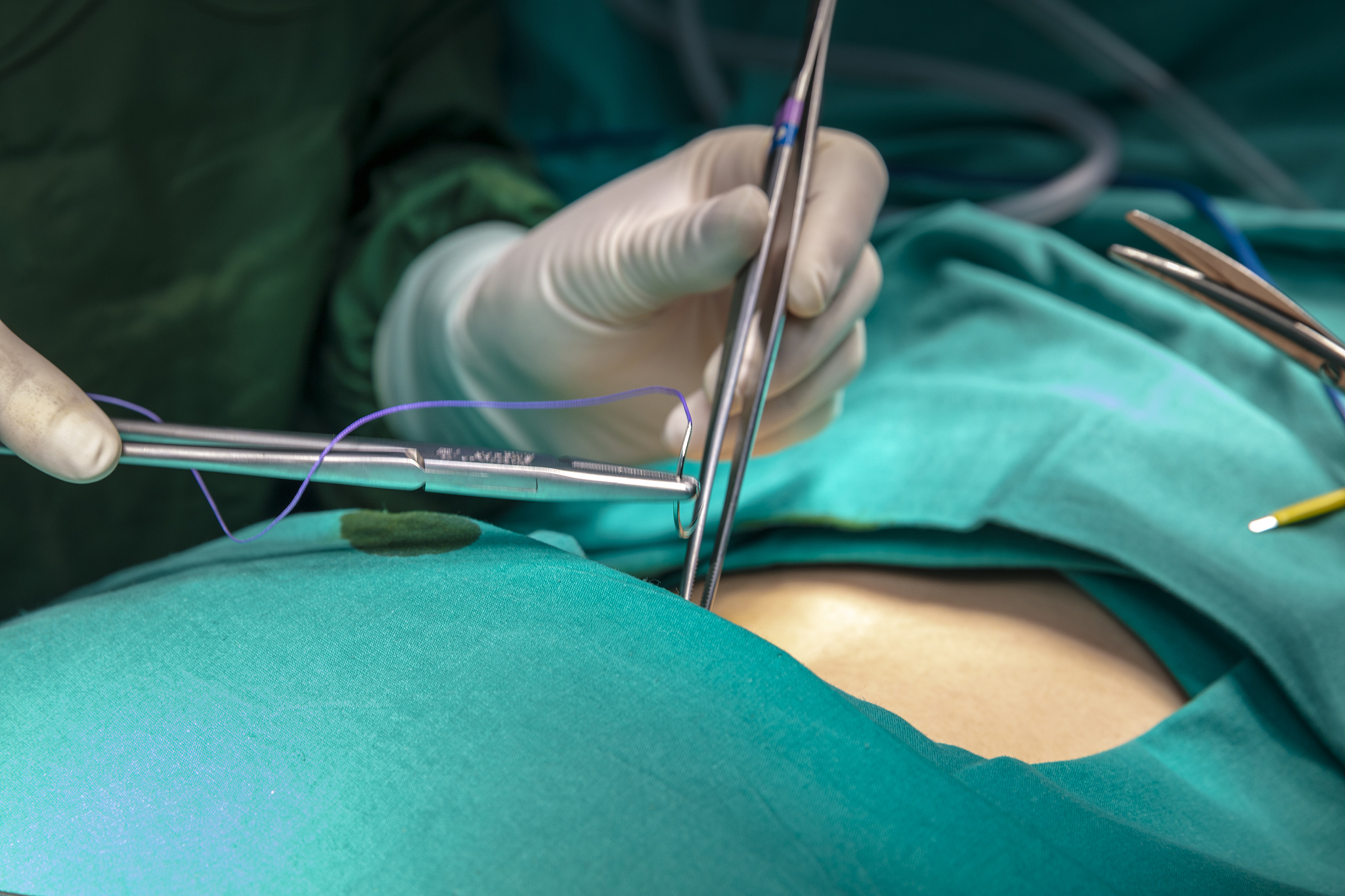 doctor make a surgical stitch