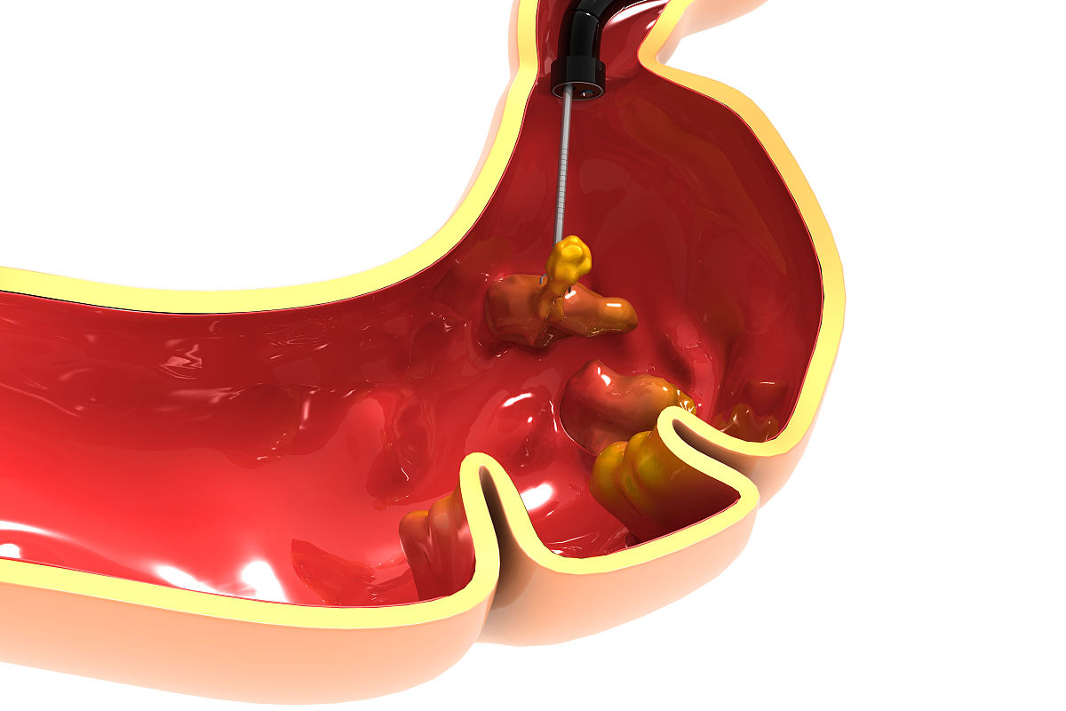 写一份12页左右的关于黑斑息肉病P-J综合征科普的PPT