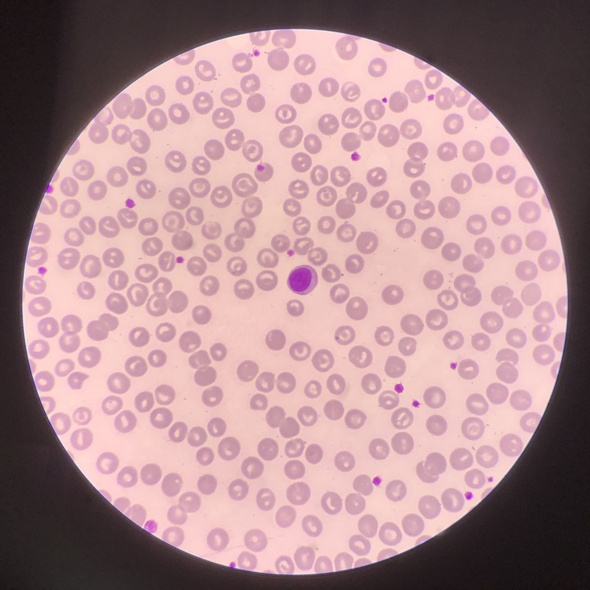 淋巴细胞降低，嗜酸性粒细胞降低，并且发烧