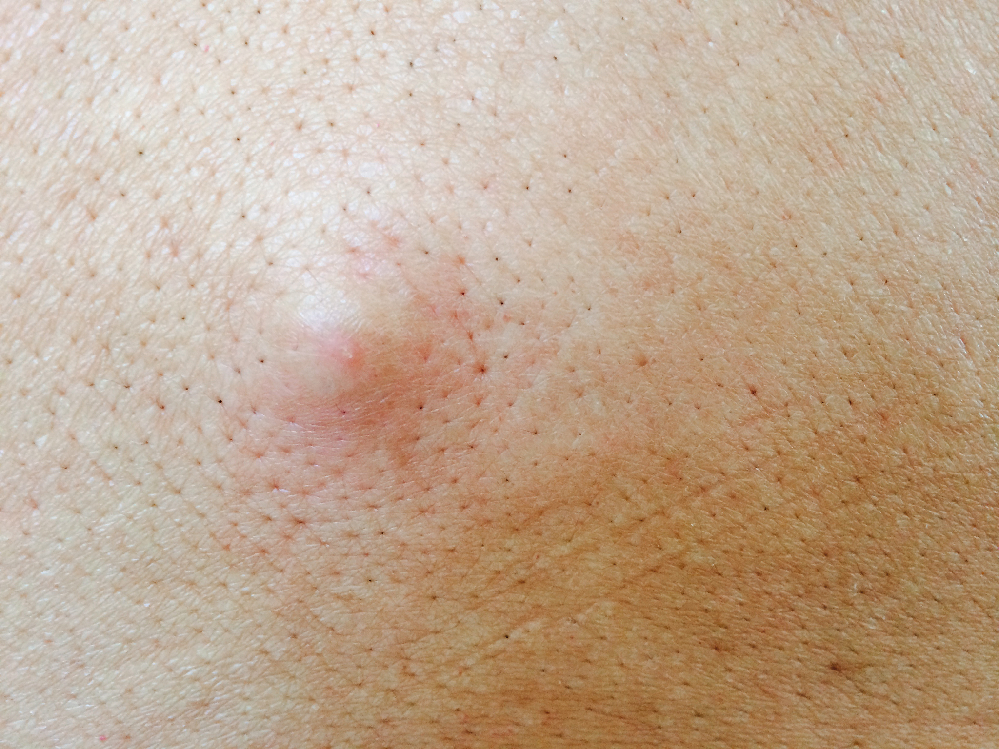 acne zit