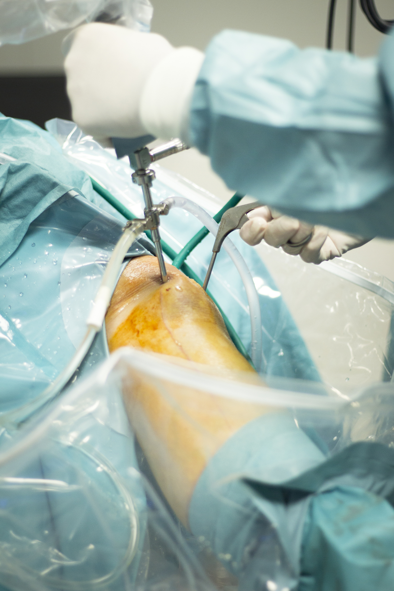 knee arthroscopy orthopedic surgery operation