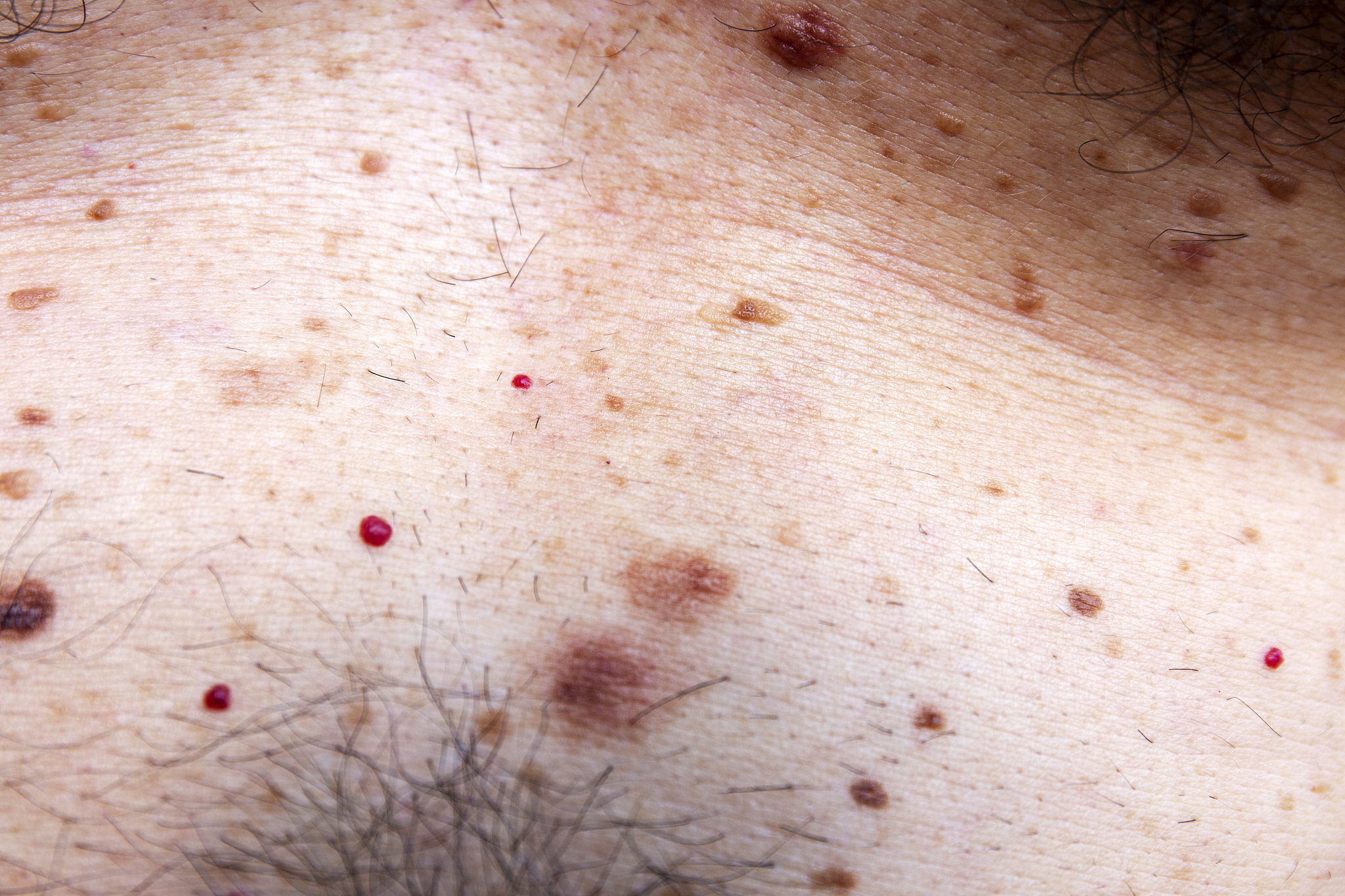 skin disease on caucasian man bust