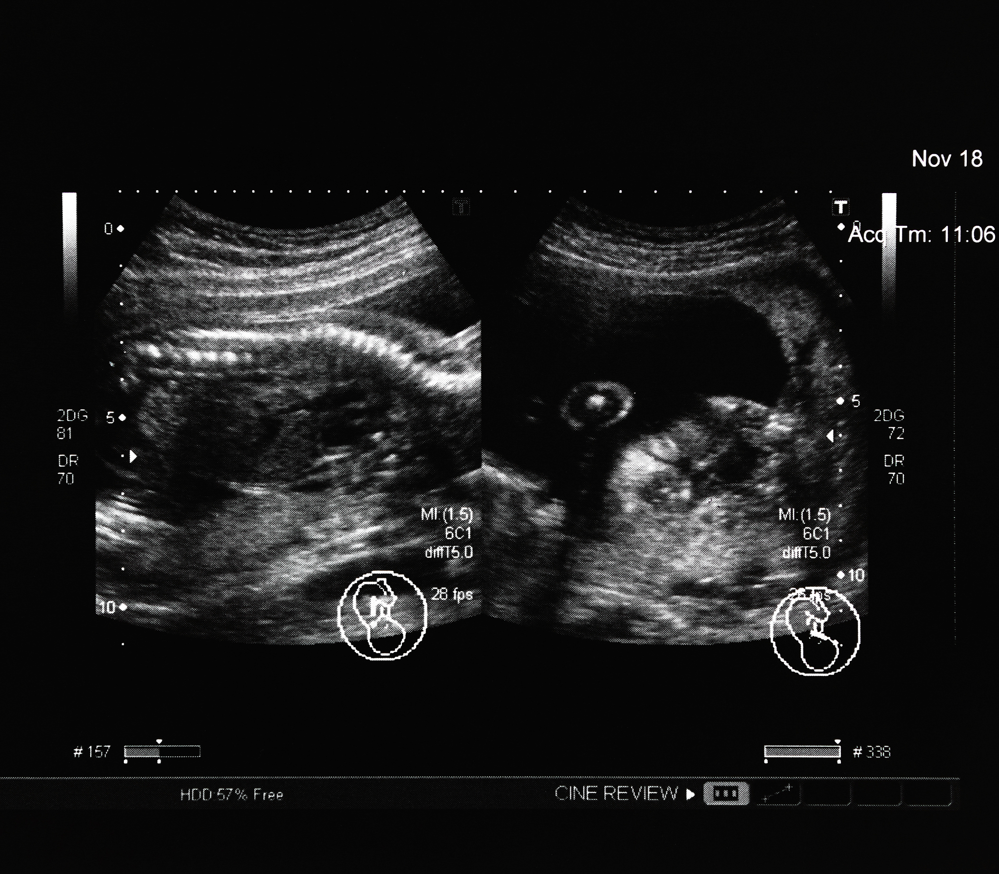 Sparse Regularization for CT Image Reconstruction: Improving Image Quality and Reducing Radiation Exposure
