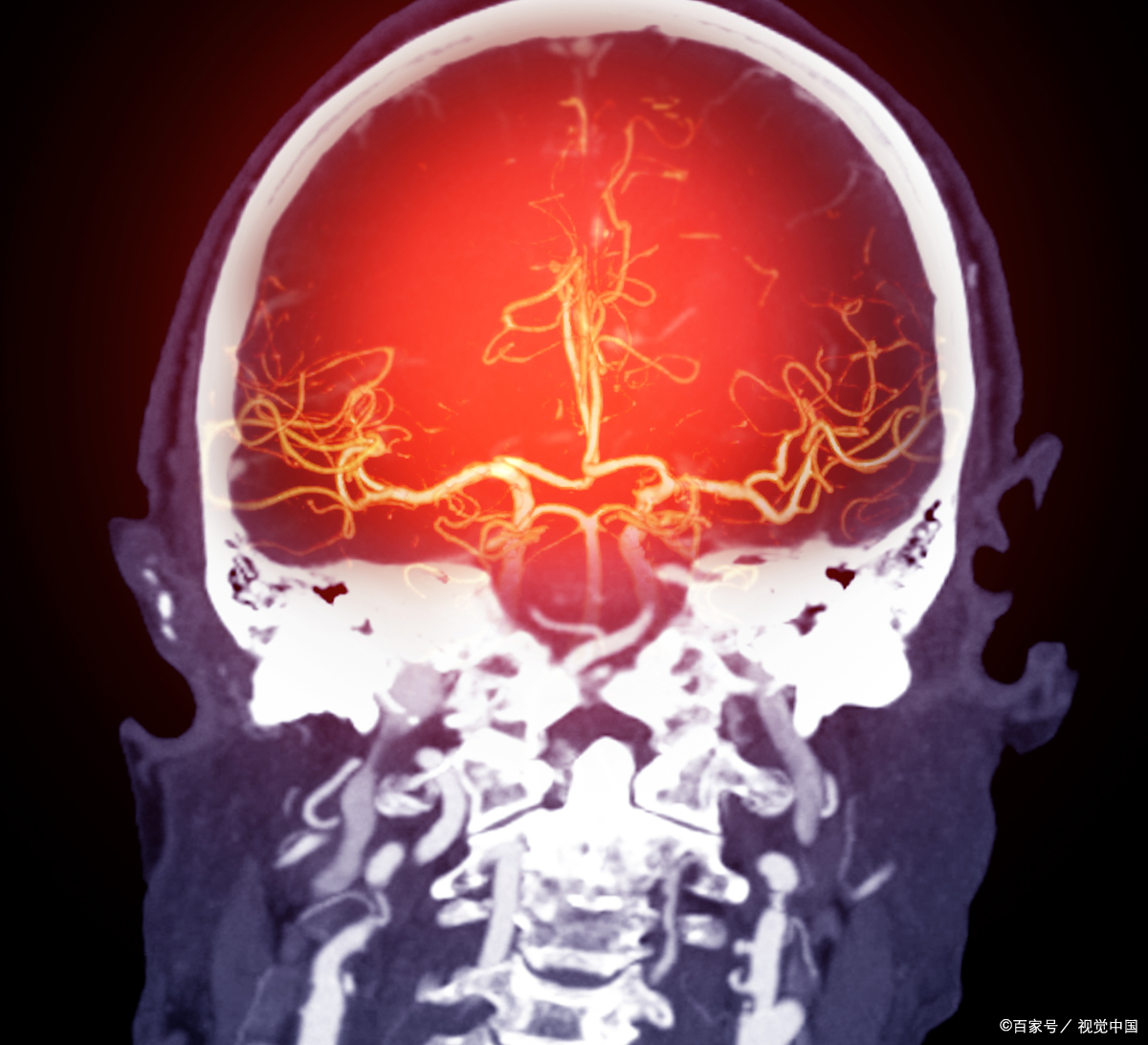我拒绝放弃妈妈”——脑干出血11.6毫升，36天的生命拉锯战