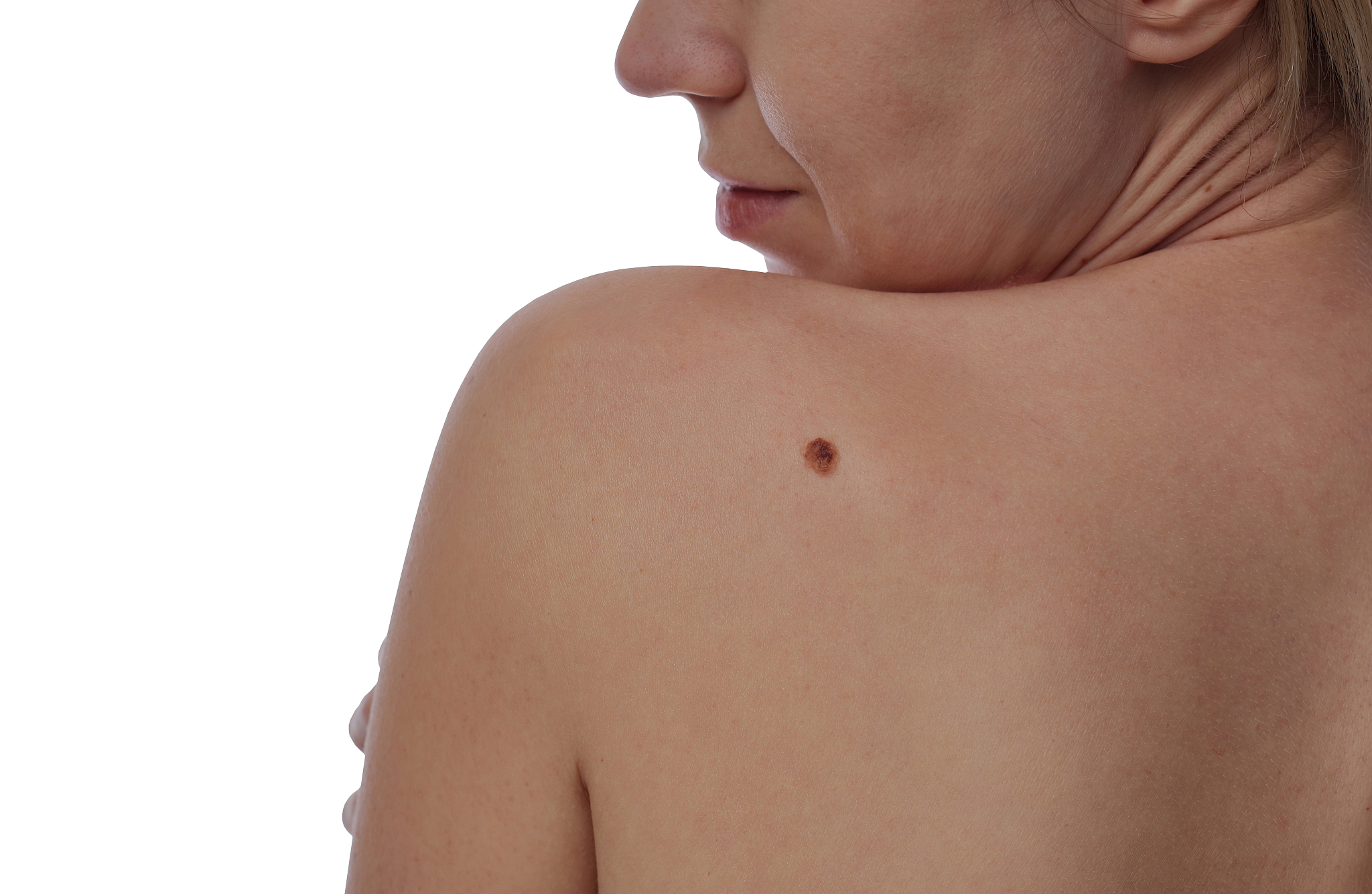 woman with birthmark on her skin isolated on white background.