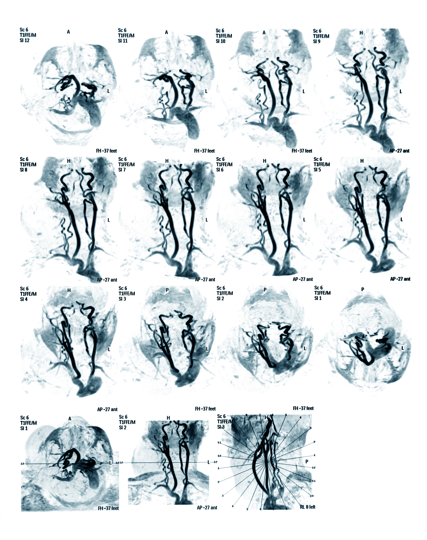 脑卒中高危人群如何进行筛查