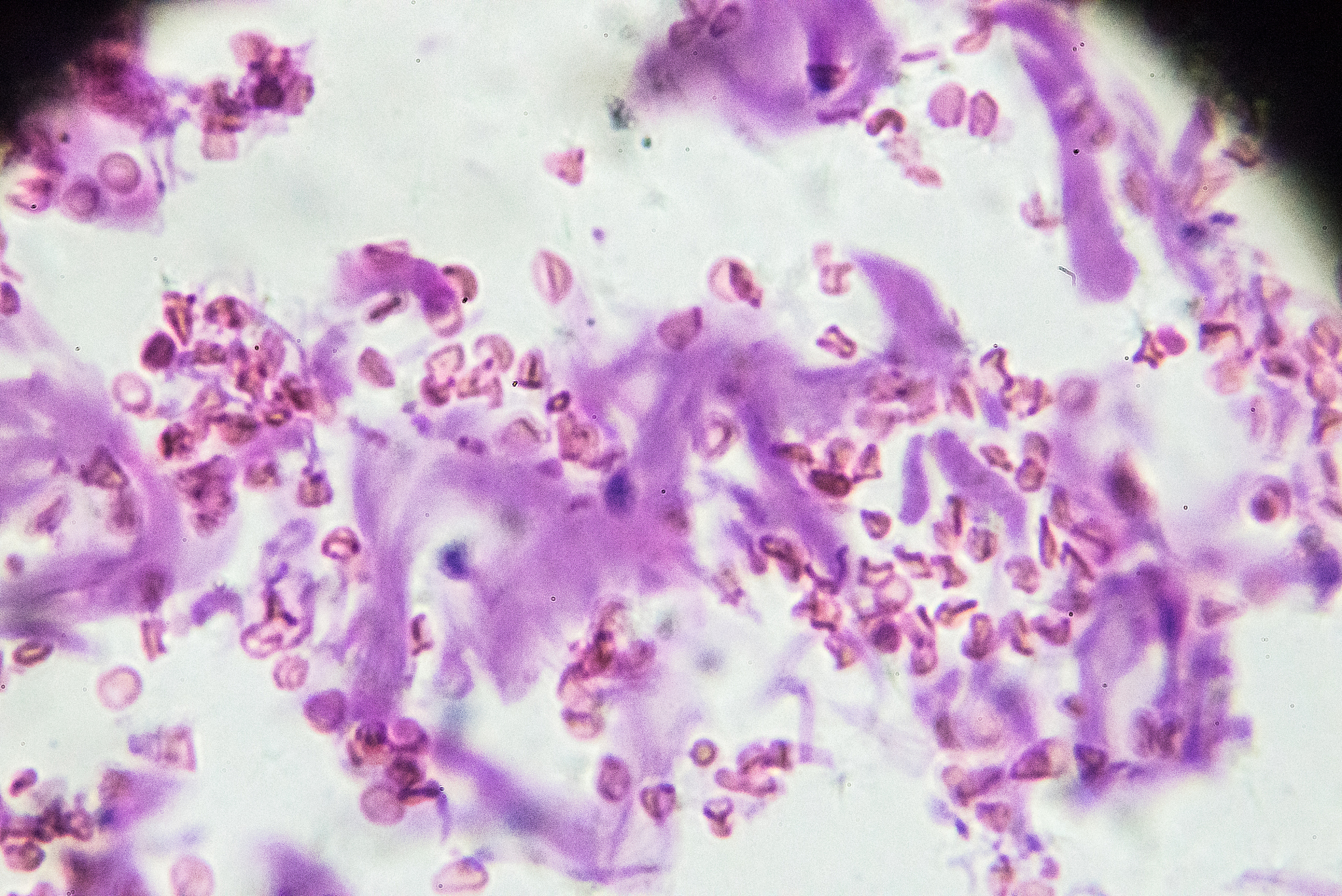 MIC-1在胃癌发生发展中的作用机制研究