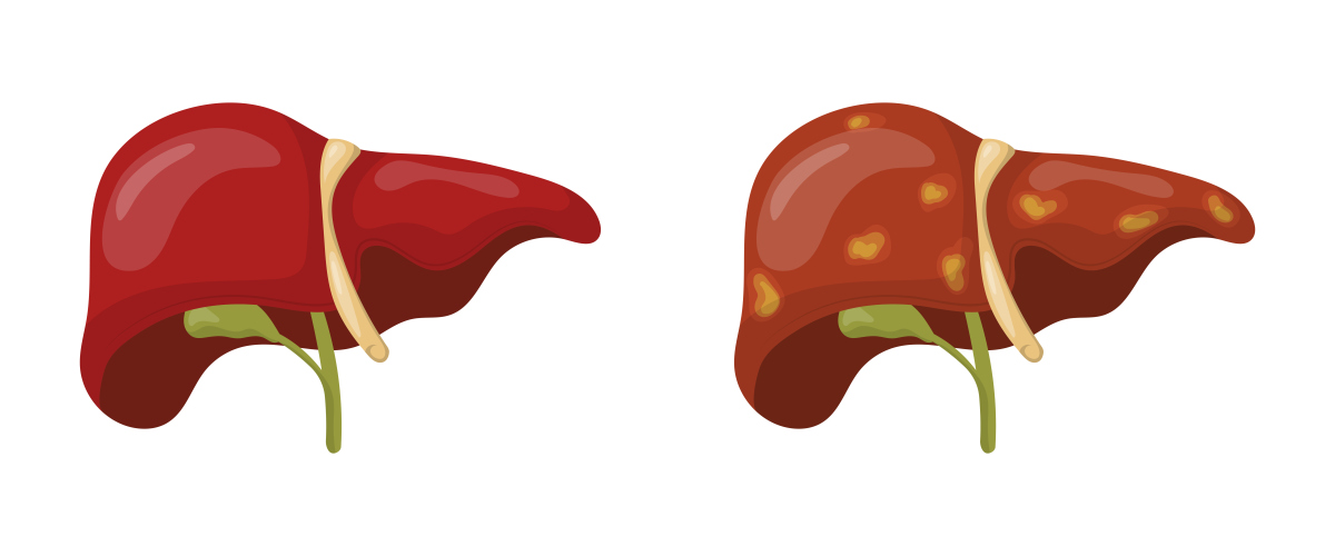 高谷丙转氨酶升高？可能是这些疾病在作祟！