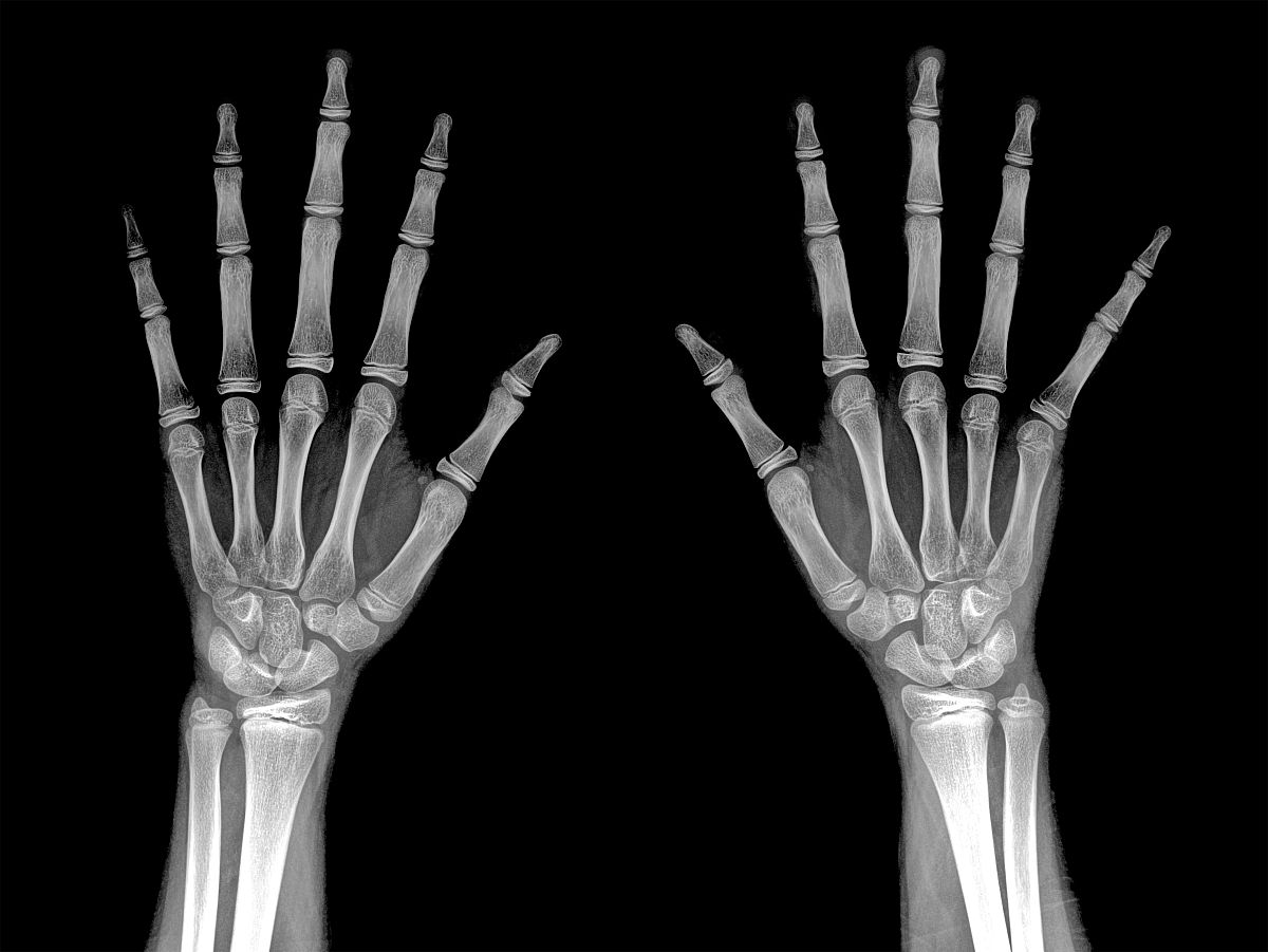 X线摄影时想要降低人体的辐射剂量可以采用 When having a radiography if you want to reduce the radiation dose of the human body you can use A低能X射线Low energy X-raysB高能X射线High energy X-raysC长曝光时间long exposure timeD短曝光时间S