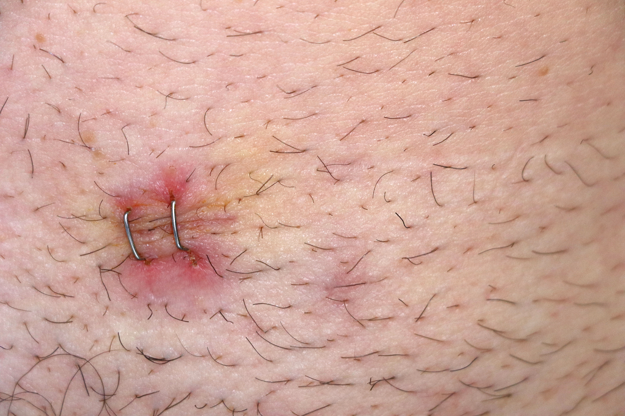 阑尾炎术恢复时间