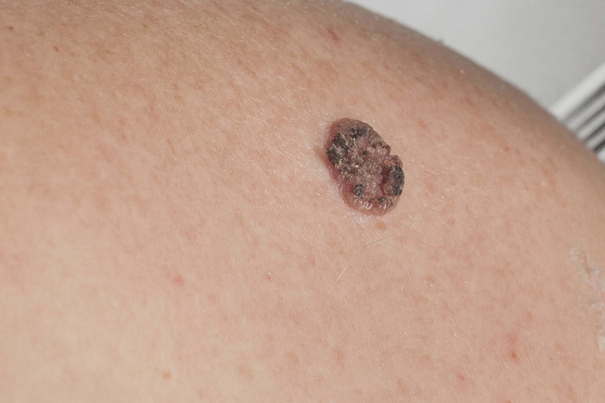 keratinizing squamous cell carcinoma of the skin