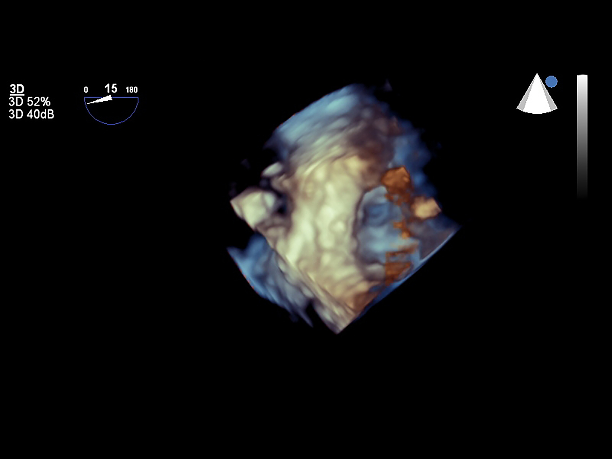 Pseudo-Shadow Removal in CT Images Using DDPM Architecture