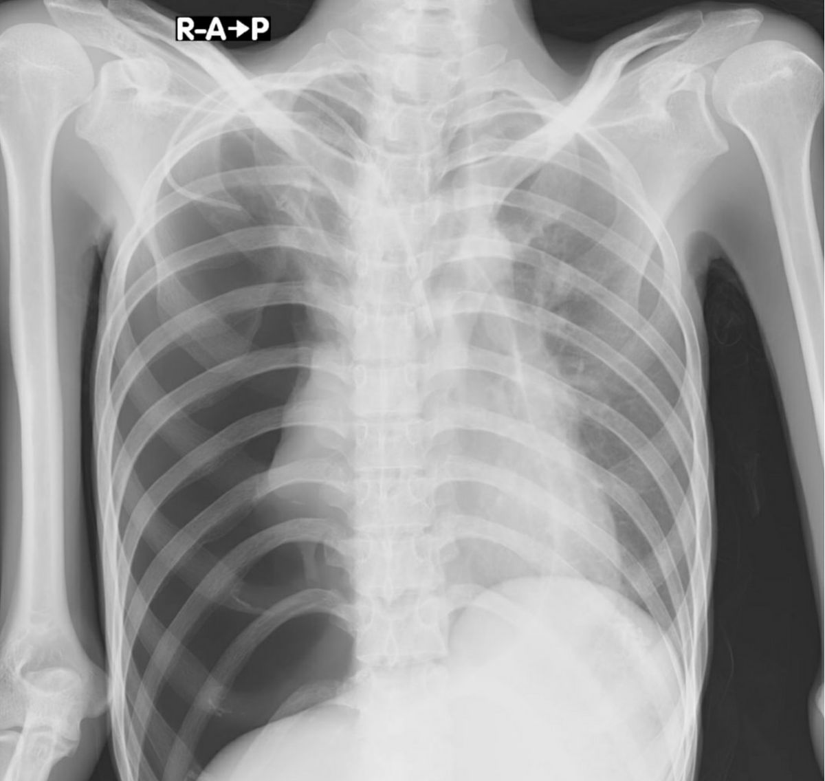 胸部肋骨骨裂：影响大吗？症状及治疗