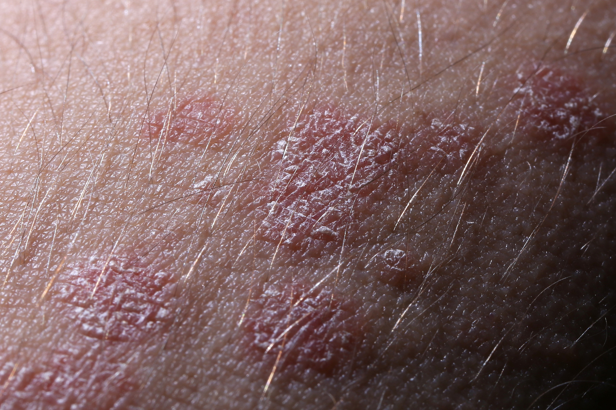 阴囊老是脱皮是什么原因