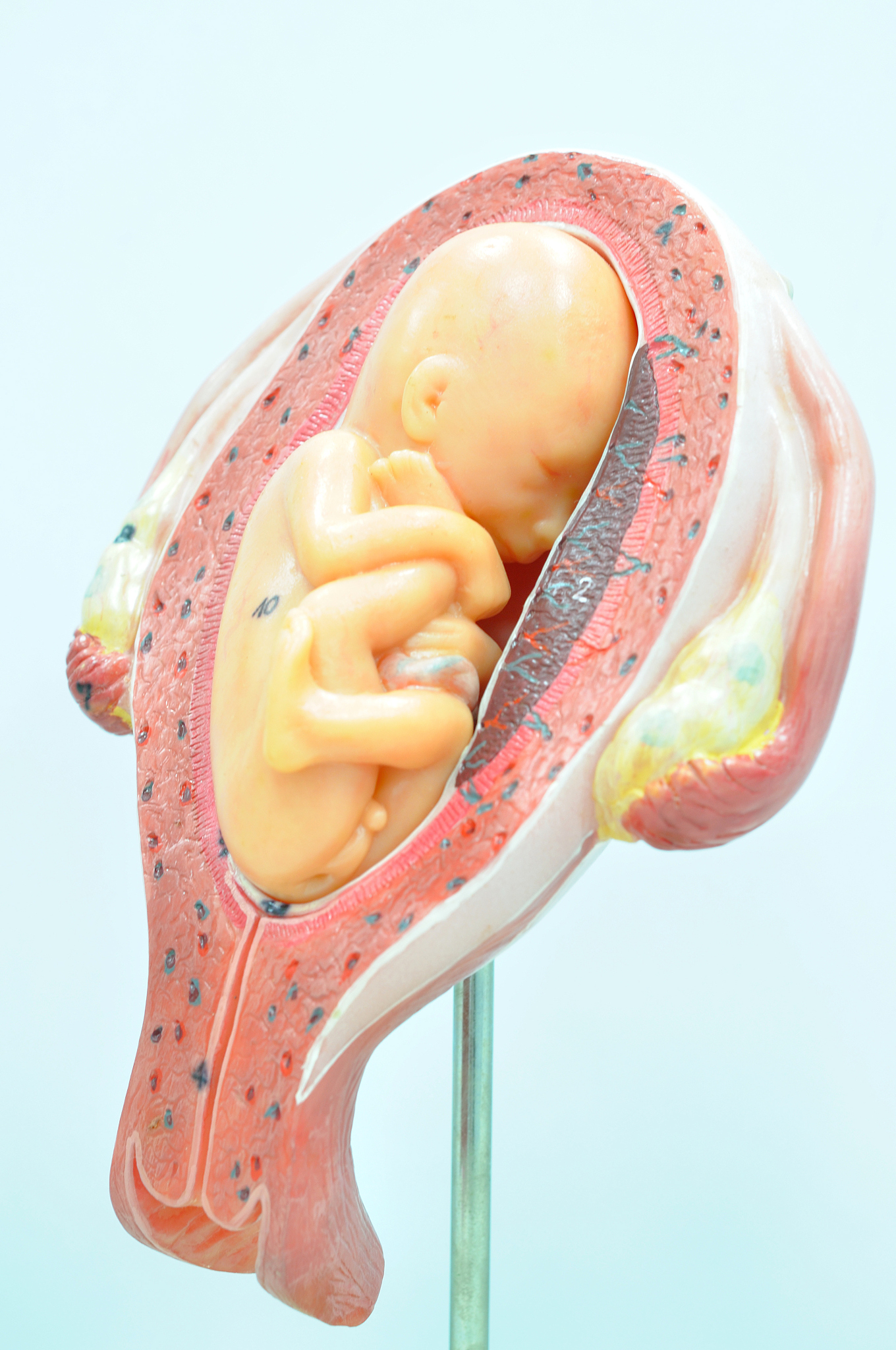 fetus in fifth month in breech presentation