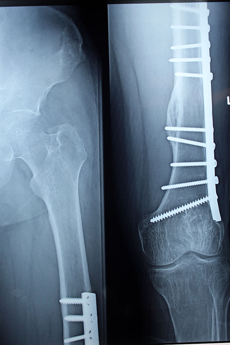 全髋关节置换术治疗老年股骨颈骨折的并发症护理