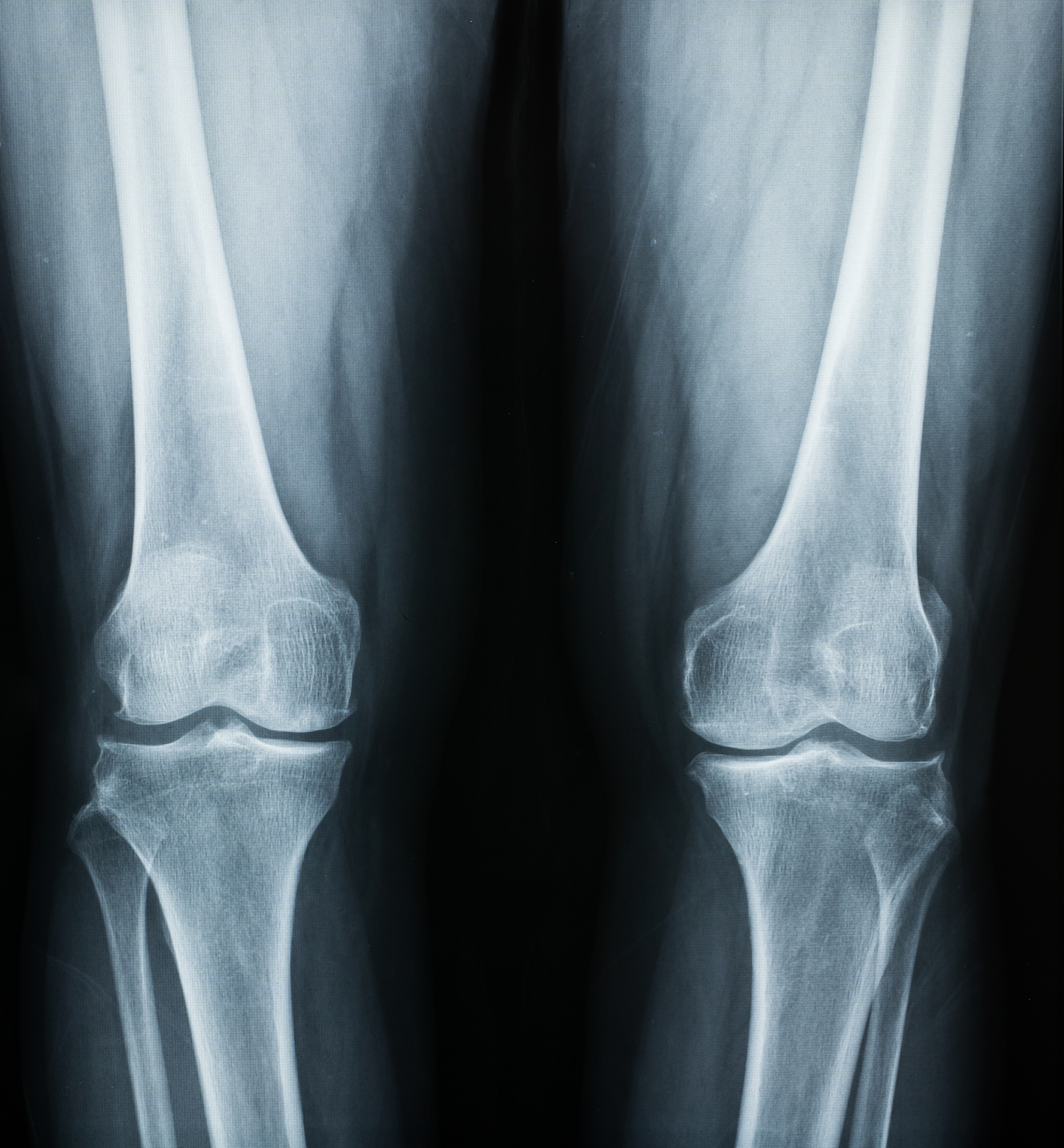 右胫骨平台粉碎性骨折及前交叉韧带撕脱: 手术治疗方案详解