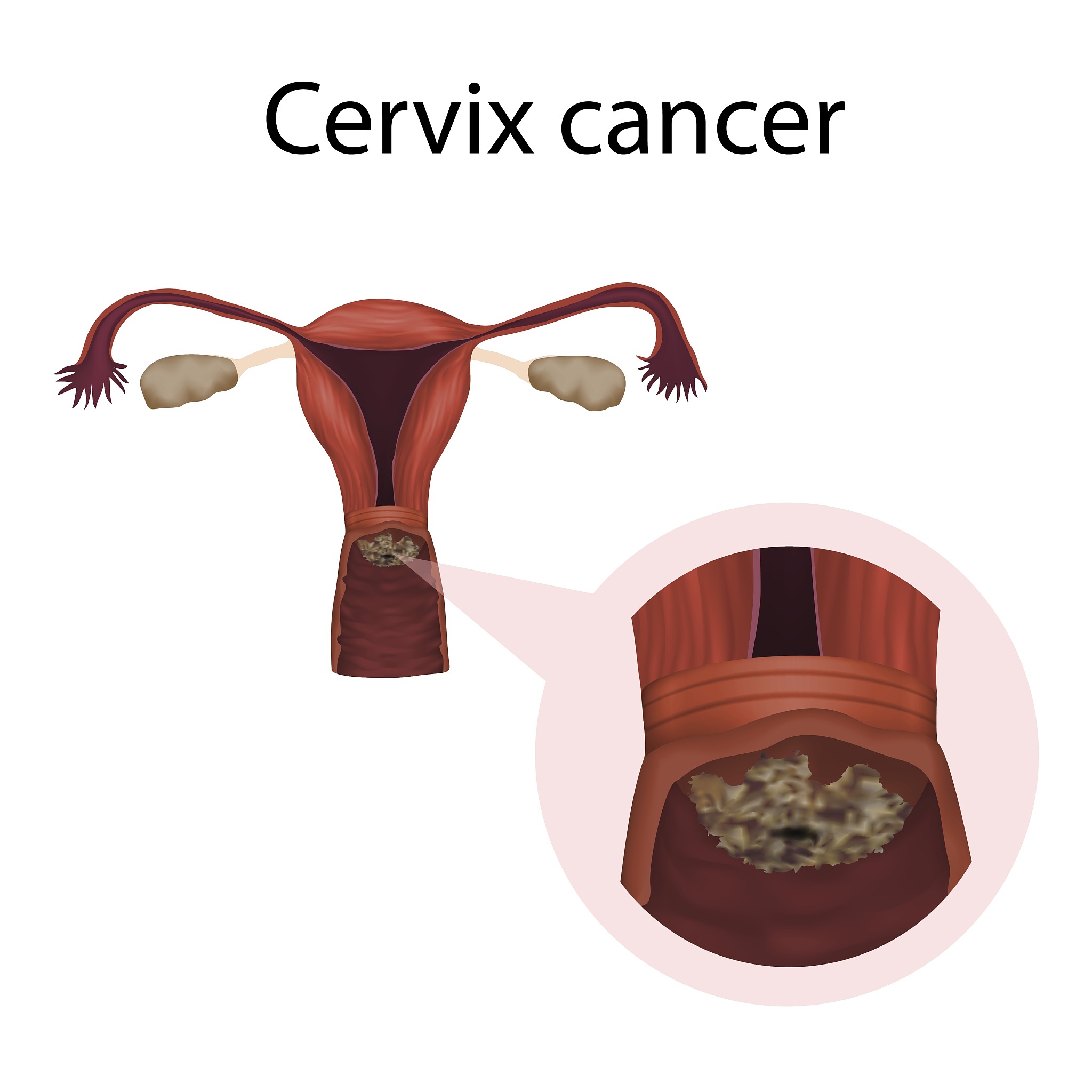 瘢痕子宫是什么？会导致不孕和流产吗？