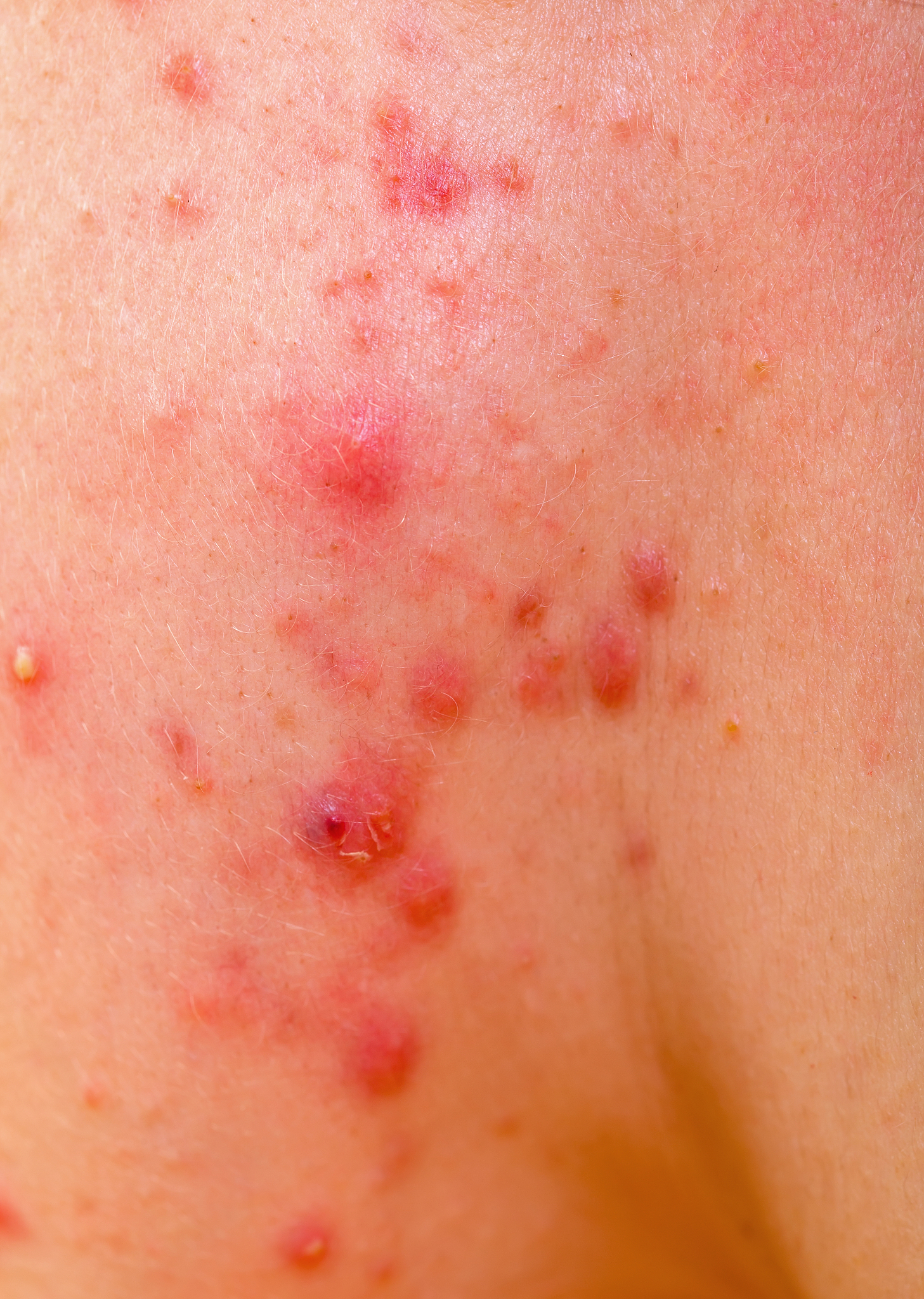 acne skin