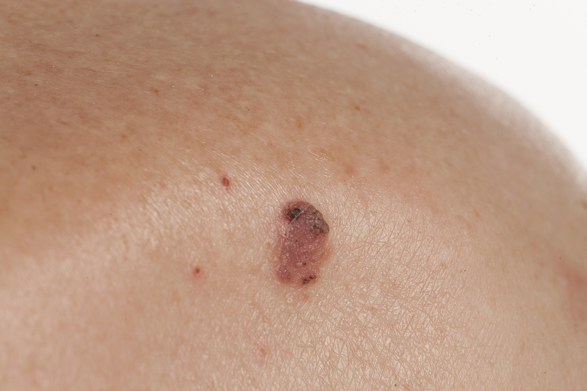 keratinizing squamous cell carcinoma of the skin
