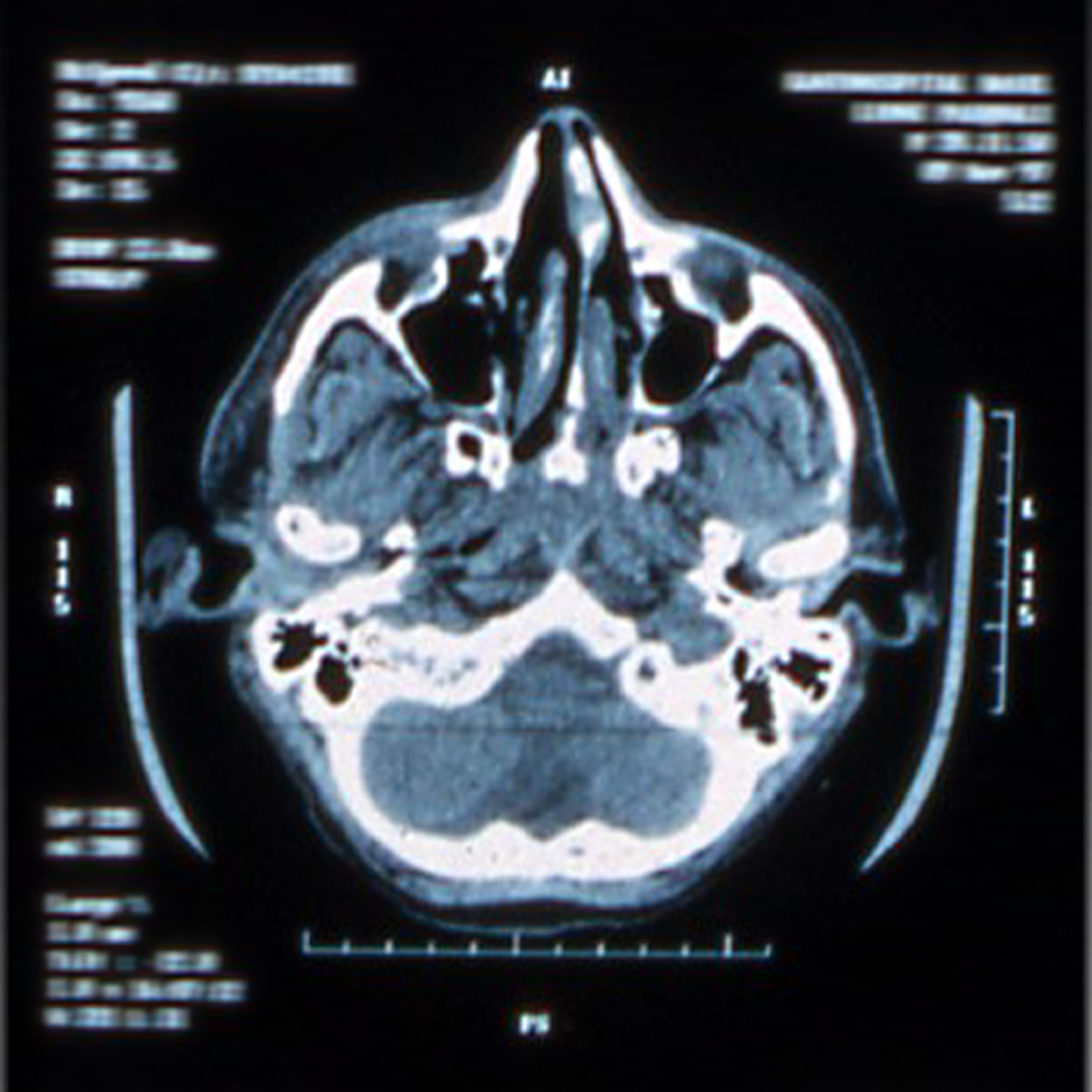 右肺小结节、右肺上叶密度增高、肺动脉旁结节、肝脏低密度影CT检查分析