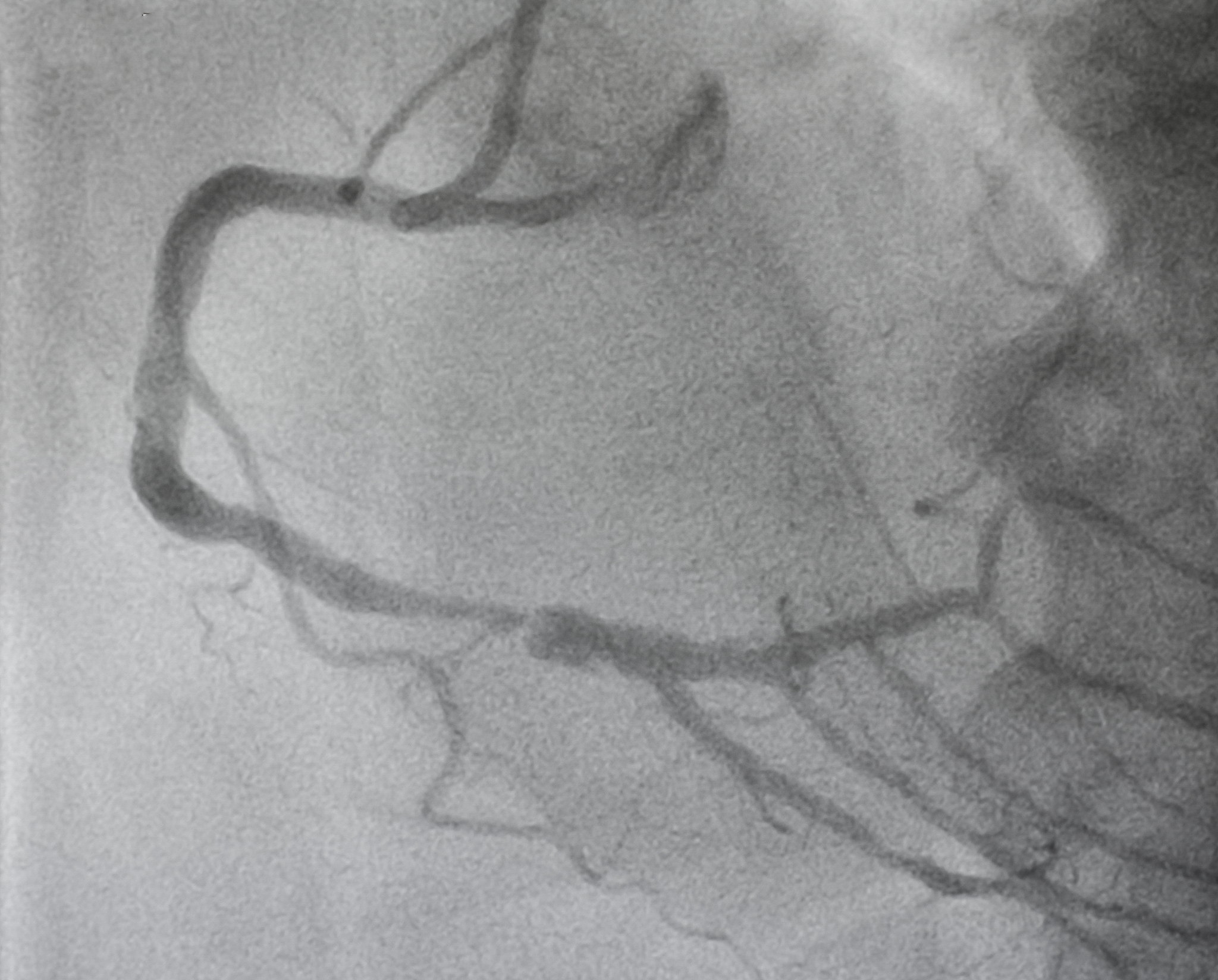 颈动脉斑块溃疡：定义及特征