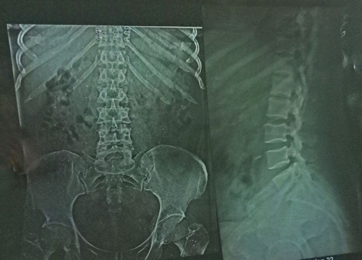 椎体成形术（PVA）适应症和禁忌症：治疗脊柱骨折和椎体压缩性骨折