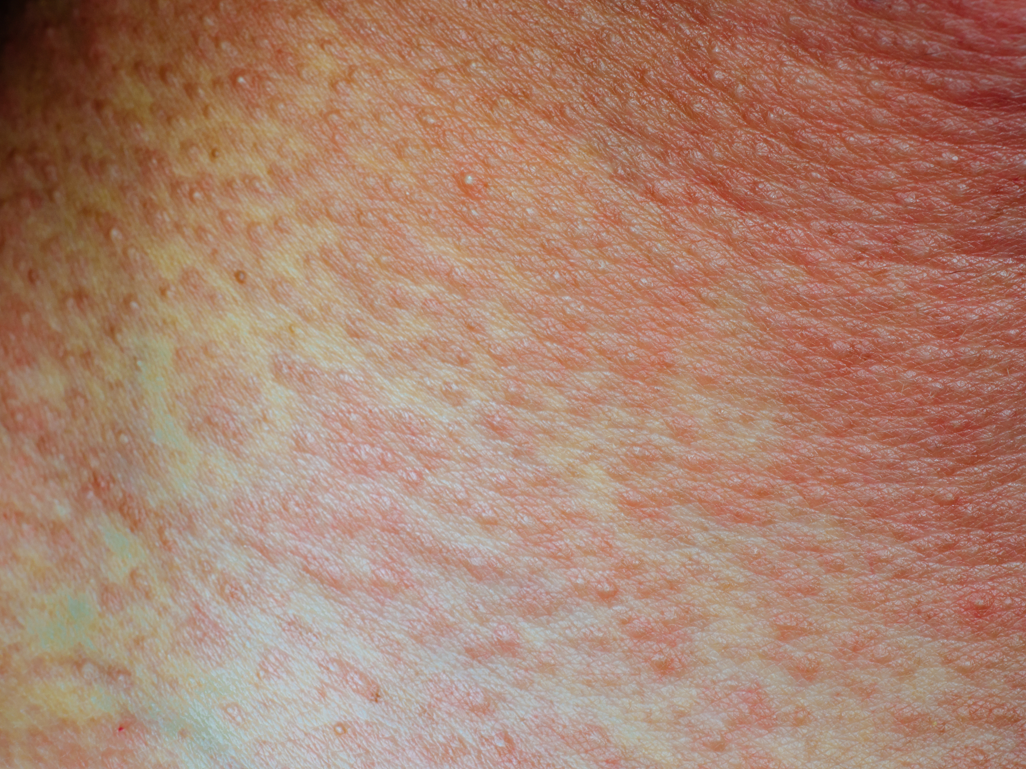 ill rash skin texture