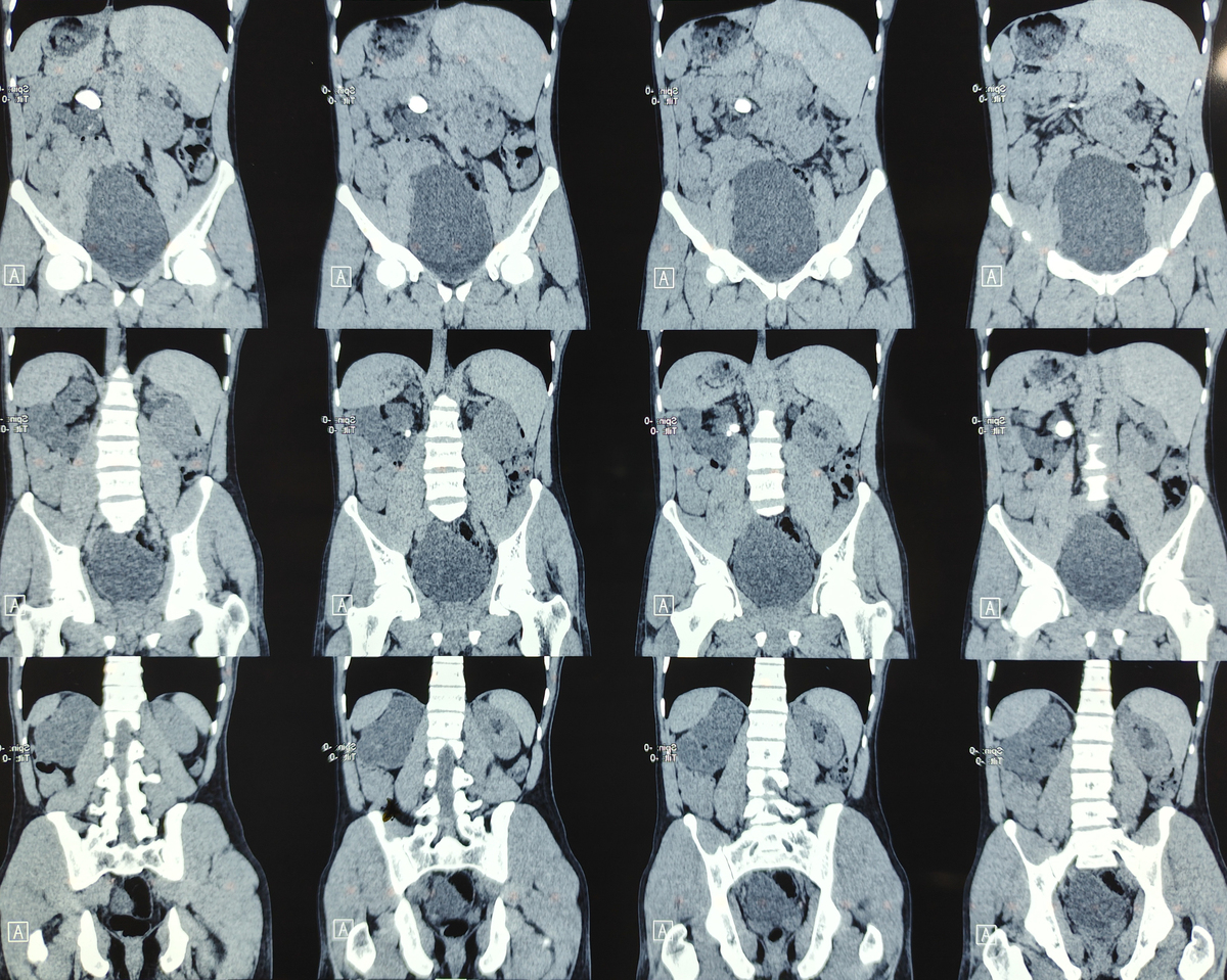 超声造影在斑块内新生血管成像中的优势